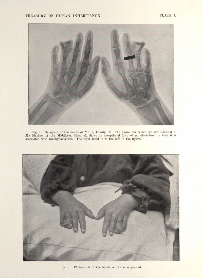 TEEASURY OF HUMAN INHERITANCE PLATE С Fig. 1. Skiagram of the hands of VI. 7, Family 19. The figure, for which we are indebted to Mr Mathew of the Middlesex Hospital, shows an exceptional form of polydactylism, in that it is associated with brachydaotylisra. The right hand is to the left in the figure. Fig. 2. Photograph of the hands of the same patient.