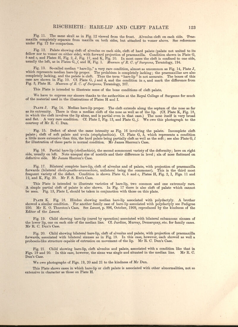 KISCHBIETH: HARE-LIP AND CLEFT PALATE 123 Fig. 11. The same skull as in Fig. 12 viewed £гош the front. Alveolus cleft on each side. Prae- maxilla completely separate from maxilla on both sides, but attached to vomer above. See references under Fig. 12 for comparison. Fig. 12. Palate showing cleft of alveolus on each side, cleft of hard palate (palate not united to its fellow nor to vomer on either side), with forward projection of praemaxilla. Condition shown in Plate Gr, Ъ and с, and Plates H, Fig. 2, J, Fig. 17, and K, Fig. 20. In most cases the cleft is confined to one side, usually the left, as in Plates G, and H, Fig. 1. Museum of R. G. of Surgeons^ Teratology, 194. Fig. 13. So-called median hare-lip, a тегу rare condition, almost as uncommon as Fig. 14, Plate J, which represents median hare-lip proper. The prolabium is completely lacking ; the praemaxillae are also completely lacking, and the palate is cleft. Thus the term  hare-lip  is not accurate. The bones of this case are shown in Fig. 10. Cf. Plate G, j and k, and the condition in e, and mark the difference from Fig. 3, Plate H. Museum of R. C. of Surgeons, Teratology, 207. This Plate is intended to illustrate some of the bone conditions of cleft palate. We liave to express our sincere thanks to the authorities at the Royal College of Surgeons for much of the material used in the illustrations of Plates H and I. Plate J. Fig. 14. Median hare-lip proper. The cleft extends along the septum of the nose as far as its extremity. There is thus a median cleft of the nose as well as of the lip. (Cf. Plate K, Fig, 18, in which the cleft involves the lip alone, and is partial even in that case.) The nose itself is very broad and flat. A very rare condition. Cf. Plate I, Fig. 13, and Plate G, j. We owe this photograph to the courtesy of Mr R. C. Dun. Fig. 15. Defect of about the same intensity as Fig. 16 involving the palate. Incomplete cleft palate ; cleft of soft palate and uvula {staphyloschisis). Cf. Plate G, Л, which Represents a condition a little more extensive than this, the hard palate being partially cleft as well as the soft, see also Plate G, I for illustration of these parts in normal condition. Mr James Sherren's Case. Fig. 16. Partial hare-Hp {cheilo8chÌ8Ì8\ the second commonest variety of the deformity; here on right side, usually on left. Note unequal size of nostrils and their difference in level ; ala of nose flattened on defective side. Mr James Sherren's Case. Fig. 17. Bilateral complete hare-lip, cleft of alveolus and of palate, with projection of praemaxilla forwards (bilateral cheilo-gnatho-uranoschisis, unilateral being the commoner). This is the third most frequent variety of the defect. Condition is shown Plate G, 6 and c, Plates H, Fig. 2, I, Figs. 11 and 12, and K, Fig. 20. Mr F. S. Eve's Case. This Plate is intended to illustrate varieties of hare-lip, two common and one extremely rare. A simple partial cleft of palate is also shown. In Fig. 17 there is also cleft of palate which cannot be seen. Fig. 13, Plate I, should be taken in conjunction with those on this plate. Plate K. Fig. 18. Hindoo showing median hare-lip associated with polydactyly. A brother showed a similar condition. For another family case of hare-lip associated with polydactyly see Pedigree 250. Mr E. 0. Thurston's Case. See Lancet^ p. 996, October, 1909, reproduced by the kindness of the Editor of the Lancet. Fig. 19. Child showing hare-lip (cured by operation) associated with bilateral submucous sinuses of the lower lip, one on each side of the median line. Cf. Jardine, Murray, Demarquay, etc. for family cases. Mr R. C. Dun's Case. Fig. 20. Child showing bilateral hare-lip, cleft of alveolus and palate, with projection of praemaxilla forwards, associated with bilateral sinuses as in Fig. 19. In this case, however, each showed as well a proboscis-like structure capable of extrusion on movement of the lip. Mr R. C. Dun's Case. Fig. 21. Child showing hare-lip, cleft alveolus and palate, associated with a condition like that in Figs. 19 and 20. In this case, however, the sinus was single and situated in the median line. Mr R. C. Dun's Case. We owe photographs of Figs. 19, 20 and 21 to the kindness of Mr Dun. This Plate shows cases in which hare-lip or cleft palate is associated with other abnormalities, not so extensive in character as those on Plate H.