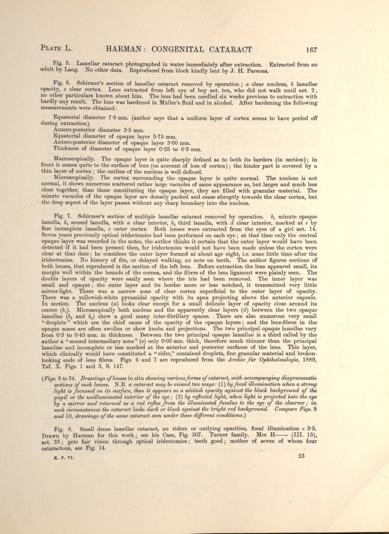 Plate L. HAEMAN : CONGENITAL CATAEACT 167 Fig. 5. Lamellar cataract photographed in water immediately after extraction. Extracted from an adult by Lang. No other data. Reproduced from block kindly lent by J. H. Parsons. Fig. 6. Scbirmer's section of lamellar cataract removed by operation ; a clear nucleus, Ъ lamellar opacity, с clear cortex. Lens extracted from left eye of boy aet. ten, who did not walk until aet. 2 ; no other particulars known about him. The lens had been needled six weeks previous to extraction with hardly any result. The lens was hardened in Miiller's fluid and in alcohol. After hardening the following measurements were obtained: ^ Equatorial diameter 7*5 mm. (author says that a uniform layer of cortex seems to have peeled off during extraction). Antero-posterior diameter 3-5 mm. Equatorial diameter of opaque layer 5*75 mm. Antero-posterior diameter of opaque layer З'ОО mm. Thickness of diameter of opaque layer 0*25 to 0*3 mm. Macroscopically. The opaque layer is quite sharply defined as to both its bprders (in section); in front it comes quite to the surface of lens (on account of loss of cortex) ; the hinder part is covered by a thin layer of cortex ; the outline of the nucleus is well defined. Microscopically. The cortex surrounding the opaque layer is quite normal. The nucleus is not normal, it shows numerous scattered rather large vacuoles of same appearance as, but larger and much lesa close together, than those constituting the opaque layer, they are filled with granular material. The minute vacuoles of the opaque layer are densely packed and cease abruptly towards the clear cortex, but the deep aspect of the layer passes without any gharp boundary into the nucleus. Fig. 7. Schirmer's section of multiple lamellar cataract removed by operation, ôj minute opaque lamella, second lamella, with a clear interior, èg third lamella, with d clear interior, marked at e by fine incomplete lamella, с outer cortex. Both lenses were extracted from the eyes of a girl aet. 14. Seven years previously optical iridectomies had been performed on each eye ; at that time only the central opaque layer was recorded in the notes, the author thinks it certain that the outer layer would have been detected if it had been present then, for iridectomies would not have been made unless the cortex were clear at that date; he considers the outer layer formed at about age eight, i.e. some little time after the iridectomies. No history of fits, or delayed walking, no note on teeth. The author figures sections of both lenses, that reproduced is the section of the left lens. Before extraction the lens appeared small, its margin well within the bounds of the cornea, and the fibres of the lens ligament were plainly seen. The double layers of opacity were easily seen where the iris had been removed. The inner layer was small and opaque ; the outer layer and its border more or less notched, it transmitted very little mirror-light. There was a narrow zone of clear cortex superficial to the outer layer of opacity. There was a yellowish-white pyramidal opacity with its apex projecting above the anterior capsule. In section. The nucleus (a) looks clear except for a small delicate layer of opacity close around its centre (6i). Microscopically both nucleus and the apparently clear layers {d) between the two opaque lamellae (62 and Ô3) show a good many inter-fibrillary spaces. There are also numerous very small droplets which are the chief cause of the opacity of the opaque layers; and the lens-fibres in the opaque zones are often swollen or show knobs and projections. The two principal opaque lamellae vary from 0*3 to 0*45 mm. in thickness. Between the two principal opaque lamellae is a third called by the author a second intermediary zone (e) only 0'05 mm. thick, therefore much thinner than the principal lamellae and incomplete or less marked at the anterior and posterior surfaces of the lens. This layer, which clinically would have constituted a  rider, contained droplets, fine granular material and broken- looking ends of lens fibres. Figs. 6 and 7 are reproduced from the Archiv für Ophthalmologie, 1889, Taf. X. Figs. 1 and 3, S. 147. {Figs, 8 to 34. Drawings of lenses in situ shovnng various forms of cataract, with accompanying diagramrtbatic sections of such lenses. N.B. a cataract may be viewed two ways: (\)by focal illumination when a strong light is focussed on its surface, then it appears as a whitish opacity against the black background of the pv/pil or the unilluminated interior of the eye ; (2) by reflected light, when light is projected into the eye by a mirror and retur^ied as a red reflex from the illuminated fundus to the eye of the observer ; in such circumstances the cataract looks dark or black against the bright red background. Compare Figs. 9 and 10, drawings of the same cataract seen under these different conditions.) Fig. 8. Small dense lamellar cataract, no riders or outlying opacities, focal illumination x 3*5» Drawn by Harman for this work; see his Case, Fig. 307. Turner family, Mrs H (III. 15), aet. 35 ; gets fair vision through optical iridectomies ; teeth good ; mother of seven of whom four cataractous, see Fig. 14. K. P. VI. 23