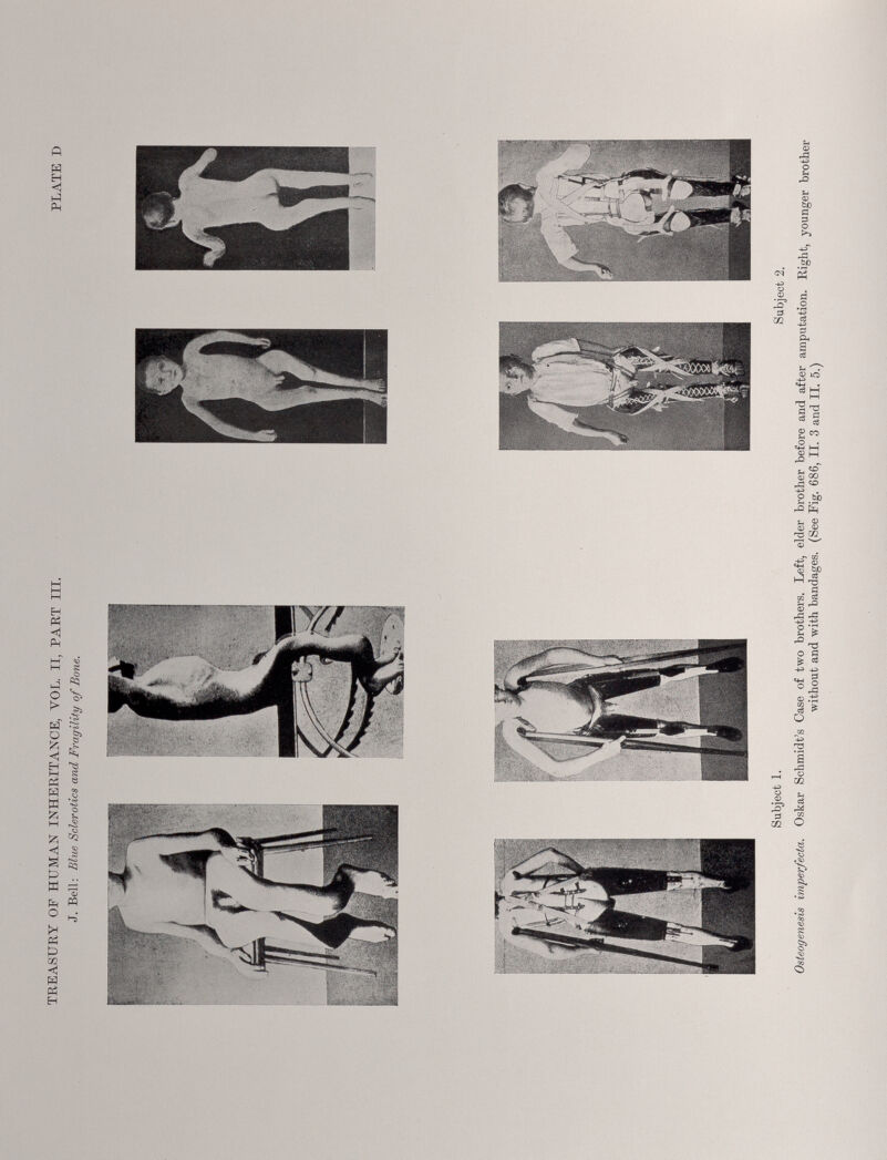 Subject 1. Subject 2. Osteogenesis imperfecta. Oskar Schmidt’s Case of two brothers. Left, elder brother before and after amputation. Ri<dit younger brother without and with bandages. (See Pig. 686, II. 3 and II. 5.)