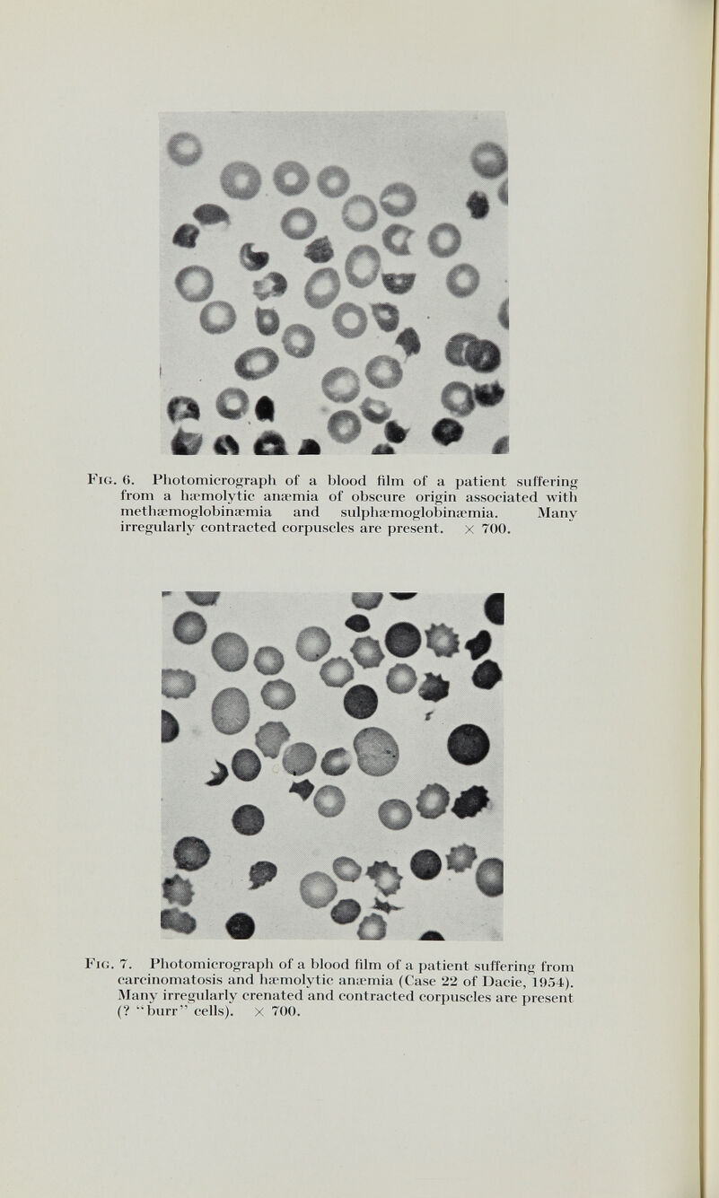 c 0°CL a O 03 % i o a o O ' Q CO * c °o o a o 4 44 A o\ < €fe o* Fig. (>. Photomicrograph of a blood film of a patient suffering from a haemolytic anaemia of obscure origin associated with methaemoglobinaemia and sulphaemoglobinaemia. Many irregularly contracted corpuscles are present. x 700. 0 D 1 •o°o?S?4 & Fig. 7. Photomicrograph of a blood film of a patient suffering from carcinomatosis and haemolytic anaemia (Case 22 of Dacie, 1954). Many irregularly crenated and contracted corpuscles are present (? “burr” cells), x 700.