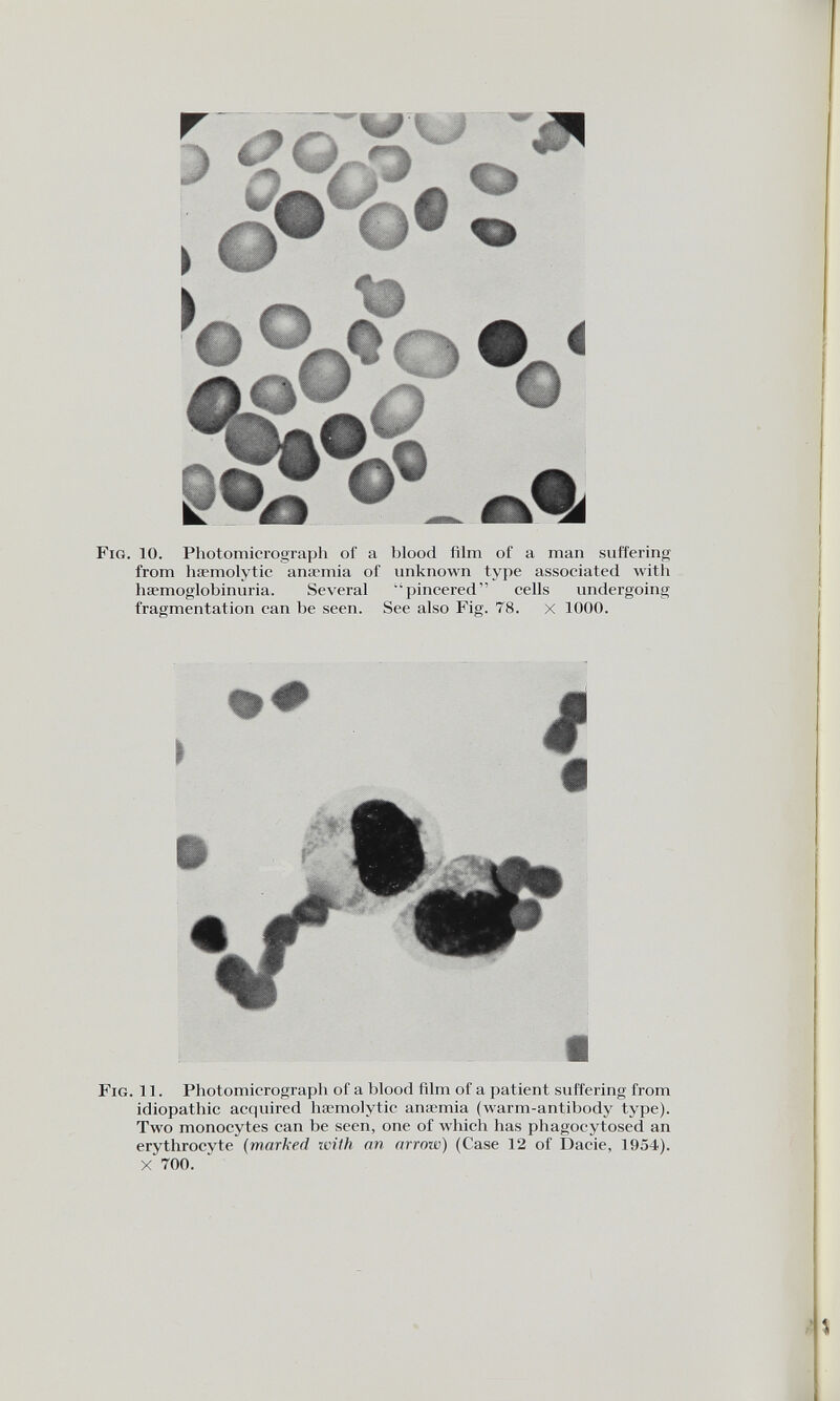 Fig. 10. Photomicrograph of a blood film of a man suffering from haemolytic anaemia of unknown type associated with haemoglobinuria. Several ‘pincered” cells undergoing fragmentation can lie seen. See also Fig. 78. X 1000. « Fig. 11. Photomicrograph of a blood film of a patient suffering from idiopathic acquired haemolytic anaemia (warm-antibody type). Two monocytes can be seen, one of which has phagocytosed an erythrocvte (marked with an arrow) (Case 12 of Dacie, 1954). X 700.
