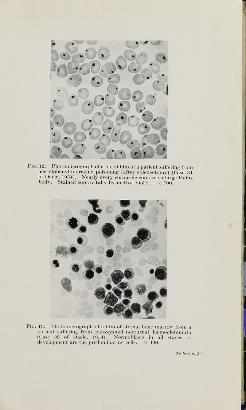 Fig. 12. Photomicrograph of a blood film of a patient suffering from acetylphenylhydrazine poisoning (after splenectomy) (Case 31 of Dacie, 1954). Nearly every corpuscle contains a large Heinz body. Stained supravitally by methyl violet. X 700. Fig. 13. Photomicrograph of a film of sternal hone marrow from a patient suffering from paroxysmal nocturnal hsemoglobinuria (Case 32 of Dacie, 1954). Normoblasts in all stages of development are the predominating cells. x 400. To face p.~ 26.