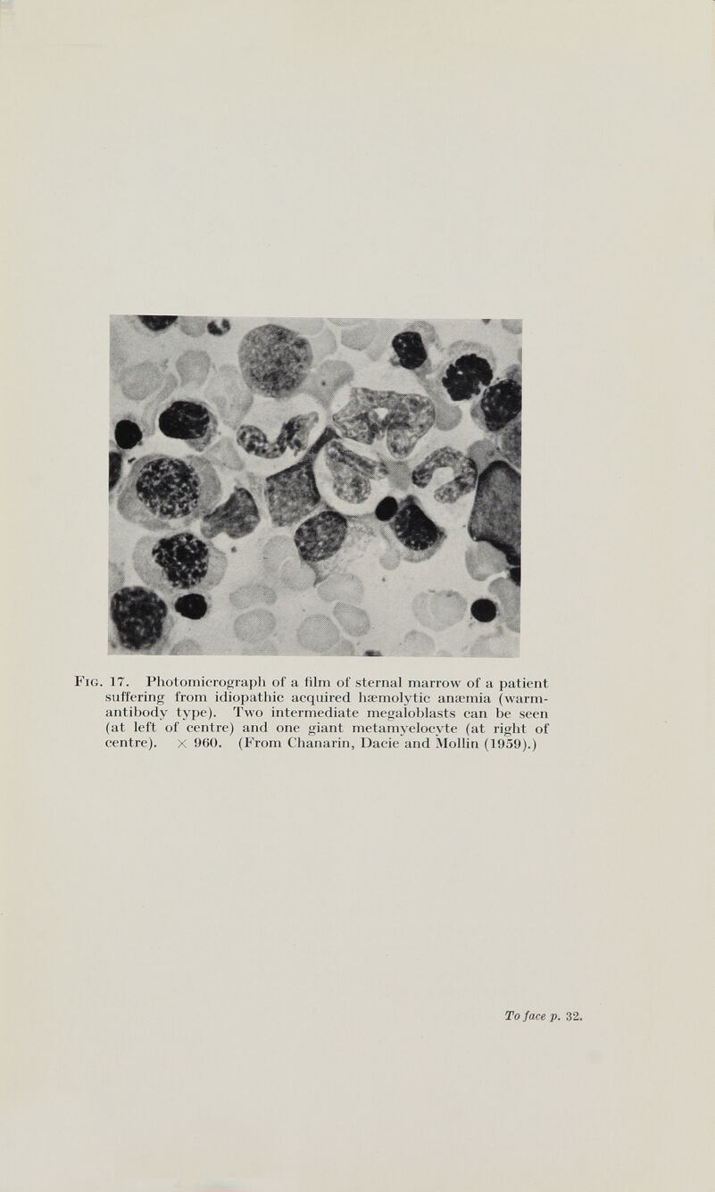 'ig. 17. Photomicrograph of a film of sternal marrow of a patient suffering from idiopathic acquired haemolytic anaemia (warm- antibody type). Two intermediate megaloblasts can be seen (at left of centre) and one giant metamyelocyte (at right of centre), x 900. (From Chanarin, Dacie and Mollin (1959).) To face p . 32.