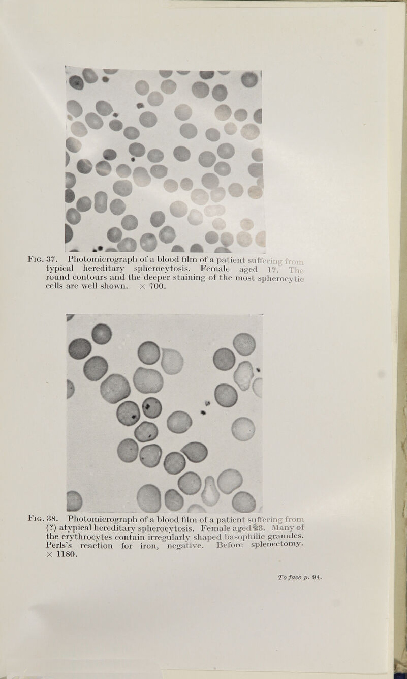 Fig. 37. Photomicrograph of a blood film of a patient suffering , typical hereditary spherocytosis. Female aged 17. The round contours and the deeper staining of the most spherocytic cells are well shown, x 700. Fig. 38. Photomicrograph of a blood film of a patient suffering from (?) atypical hereditary spherocytosis. Female aged %3. Many of the erythrocytes contain irregularly shaped basophilic granules. Perls’s reaction for iron, negative. Before splenectomy. X 1180.