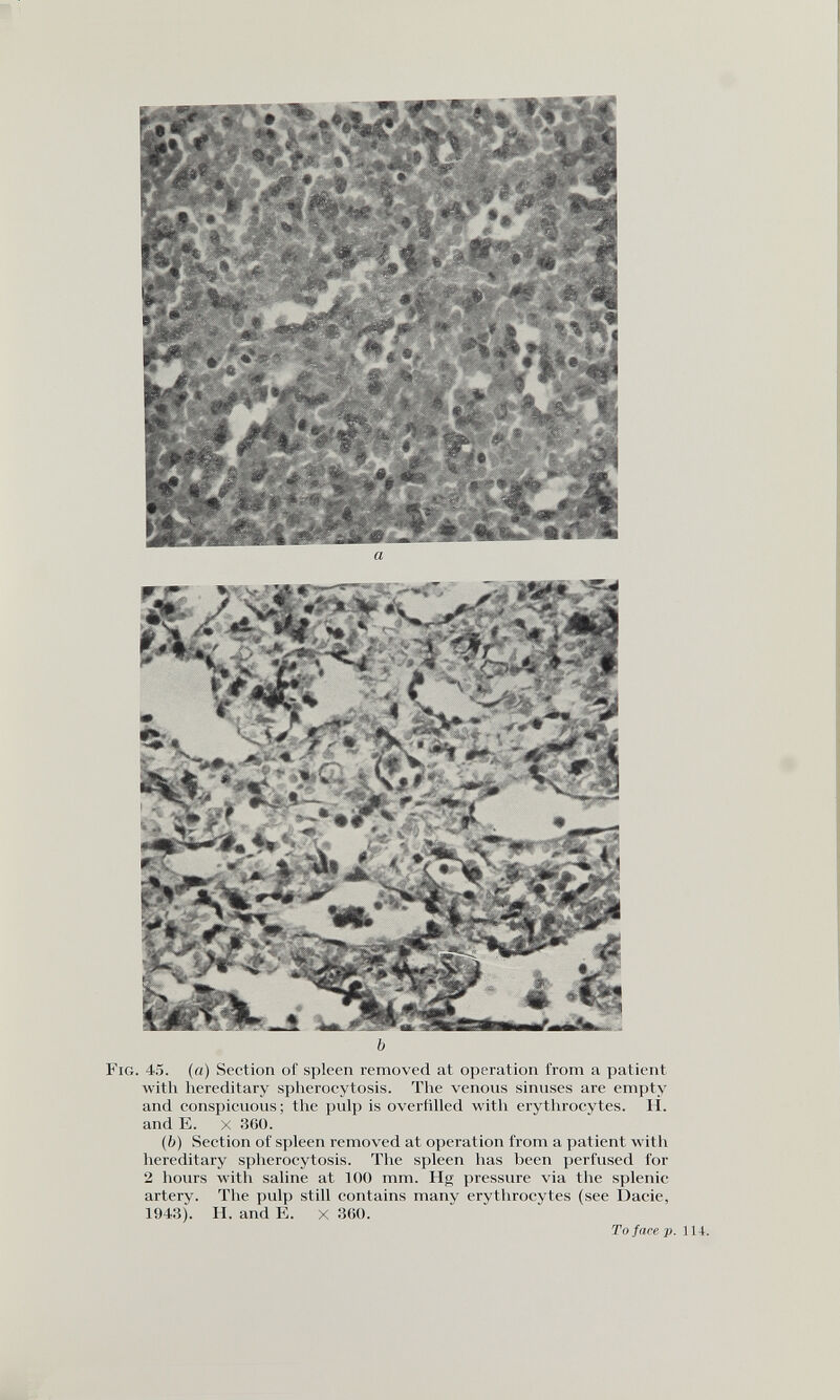 a b Fig. 45. («) Section of spleen removed at operation from a patient with hereditary spherocytosis. The venous sinuses are empty and conspicuous; the pulp is overfilled with erythrocytes. H. and E. x 360. (b) Section of spleen removed at operation from a patient with hereditary spherocytosis. The spleen has been perfused for 2 hours with saline at 100 mm. Hg pressure via the splenic artery. The pulp still contains manv erythrocytes (see Dacie, 1943). H. and E. x 360. To face p . 114.