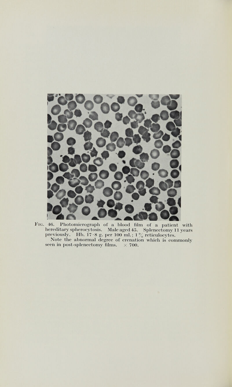 Fig. 46. Photomicrograph of a blood film of a patient with hereditary spherocytosis. Male aged 4.5. Splenectomy 11 years previously. Hh. 17-8 g. per 100 ml.; 1 % reticulocytes. Note the abnormal degree of crenation which is commonly seen in post-splenectomy films. X 700.