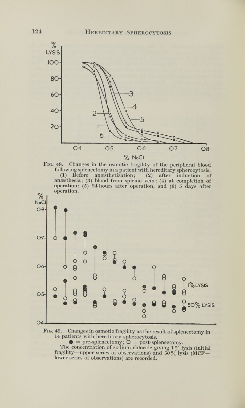 Fig. 48. Changes in the osmotic fragility of the peripheral blood following splenectomy in a patient with hereditary spherocytosis. (1) Before anesthetization; (2) after induction of Fig. 49. Changes in osmotic fragility as the result of splenectomy in 14 patients with hereditary spherocytosis. • = pre-splenectomy; O = post-splenectomy. The concentration of sodium chloride giving 1 % lysis (initial fragility—upper series of observations) and 50 % lysis (MCF— lower series of observations) are recorded.