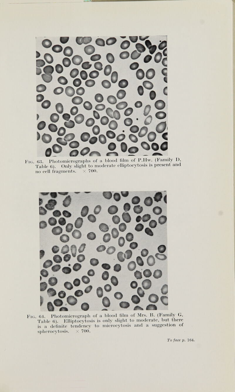 r n\&°oVoo S I, 00 «? 0 O ® • • < ► O'X.^o fv VfV^ >0 «¿ 2 L©* 0 o <? flO 2 <V% Fig. 63. Photomicrographs of a blood film of P.Hw. (Family 1), Table 6). Only slight to moderate elliptocytosis is present and no cell fragments. X 700. Fig. Of. Photomicrograph of a blood film of Mrs. B. (Family G. Table 6). Elliptocytosis is only slight to moderate, but there is a definite tendency to microcytosis and a suggestion of spherocytosis, x 700. To face p. 164.
