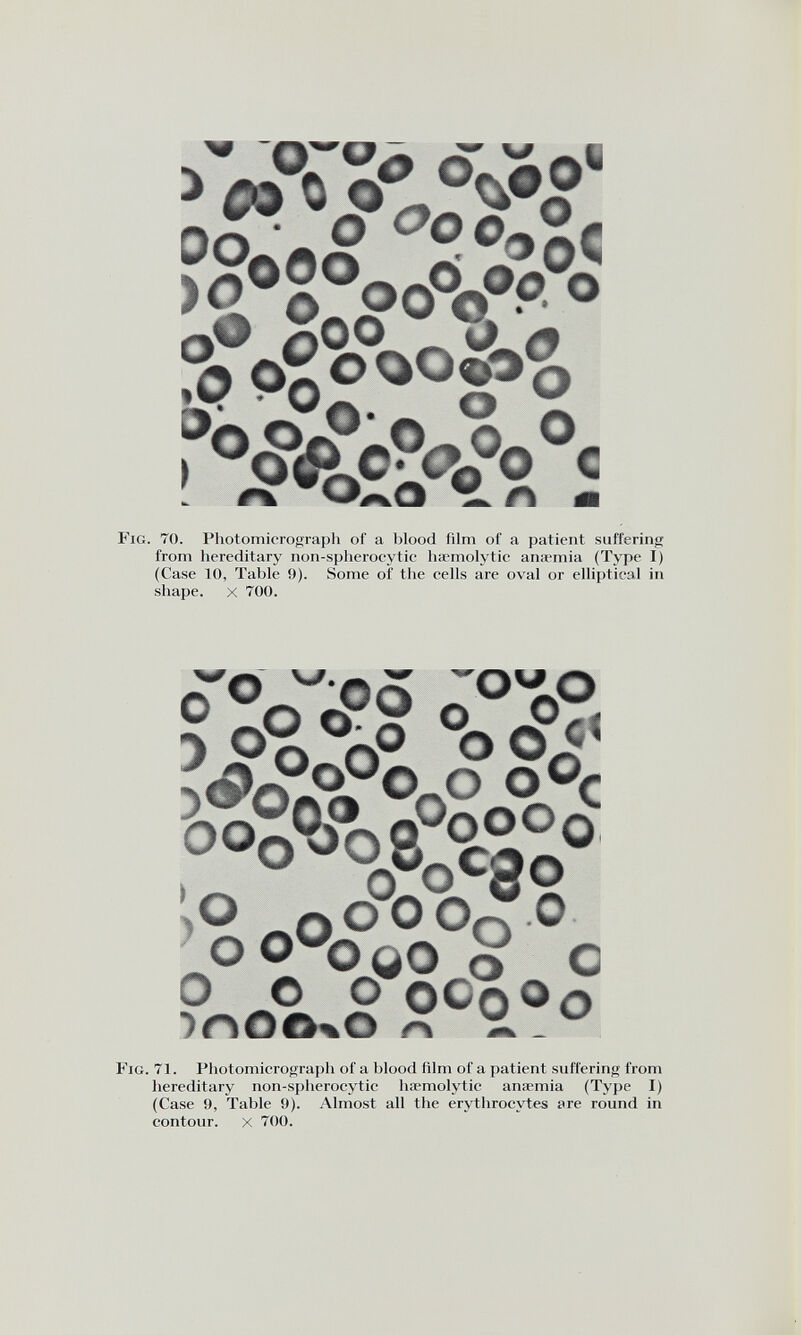 OO, )0 o O o°oo ° ° °^*o ■jqC o ooo^ -Oj3o o uL • * 0-^0 <Q[ © 9 ?, O Q«?® 0 ° <> a ft» w O “ n Fig. 70. Photomicrograph of a blood film of a patient suffering from hereditary non-spheroeytic haemolytic anaemia (Type I) (Case 10, Table !)). Some of the cells are oval or elliptical in shape, x 700. o«o O 0-1 OOi* j'O-O 0°c 0° oa °9 ooo°ooS°|p 1 d • y o n 0 d°oto o O w O qO o c o o O OOqOq Fig. 71. Photomicrograph of a blood film of a patient suffering from hereditary non-spherocytic haemolytic anaemia (Type I) (Case 9, Table 9). Almost all the erythrocytes are round in contour. x 700.