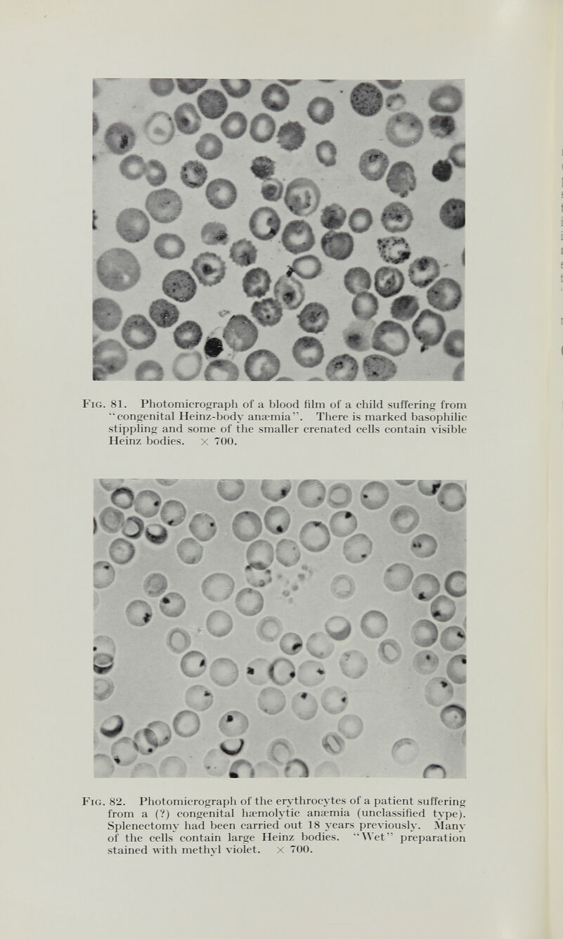Fig. 81. Photomicrograph of a blood Him of a child suffering from congenital Heinz-body anaemia”. There is marked basophilic stippling and some of the smaller crenated cells contain visible Heinz bodies. X 700. Fig. 82. Photomicrograph of the erythrocytes of a patient suffering from a (?) congenital haemolytic anaemia (unclassified type). Splenectomy had been carried out 18 years previously. Many of the cells contain large Heinz bodies. '‘Wet” preparation stained with methyl violet, x 700.
