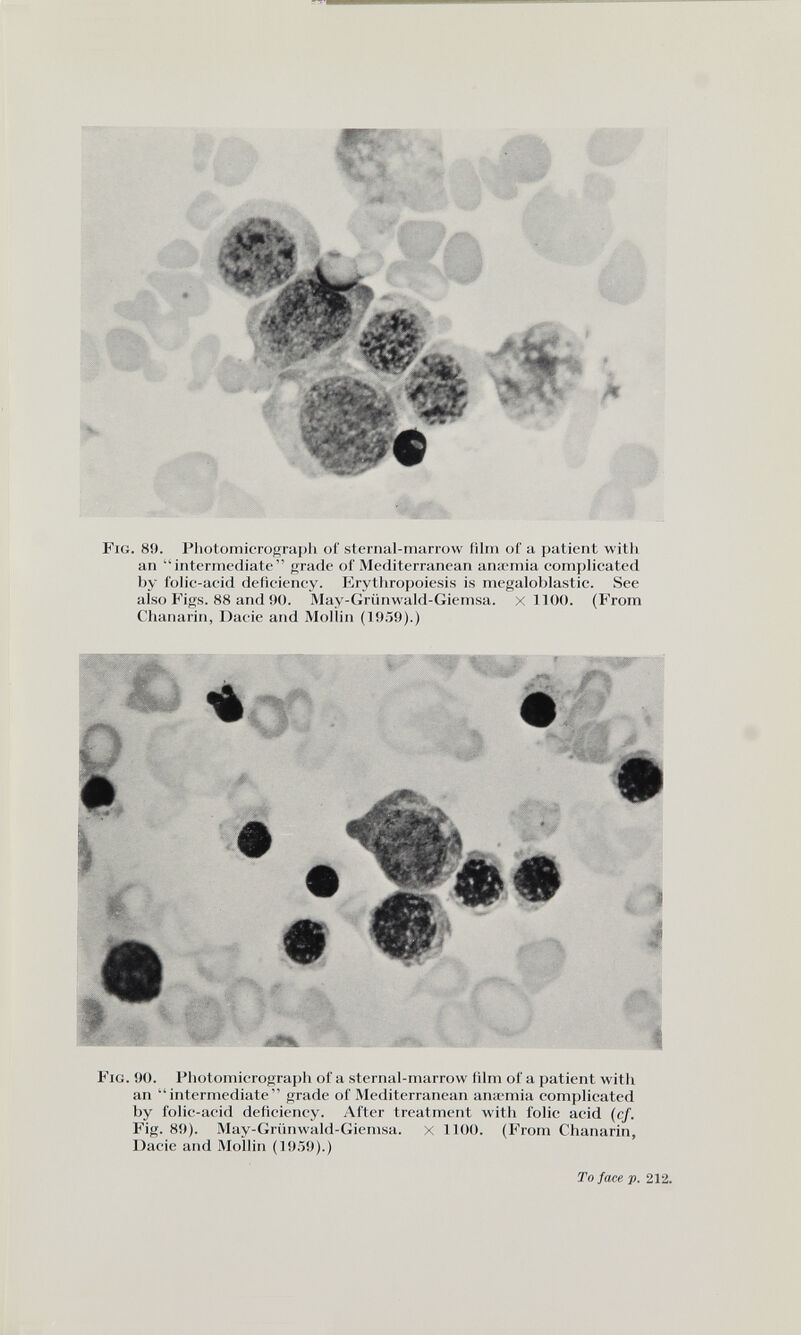 Fig. 89. Photomicrograph of sternal-marrow film of a patient with an “intermediate” grade of Mediterranean anaemia complicated by folic-acid deficiency. Erythropoiesis is megaloblastic. See also Figs. 88 and 90. May-Grunwald-Giemsa. x 1100. (From Chanarin, Dacie and Mollin (1959).) Fig. 90. Photomicrograph of a sternal-marrow film of a patient with an “intermediate” grade of Mediterranean anaemia complicated by folic-acid deficiency. After treatment with folic acid (c/. Fig. 89). May-Griinwald-Giemsa. x 1100. (From Chanarin, Dacie and Mollin (1959).) To face p. 212.