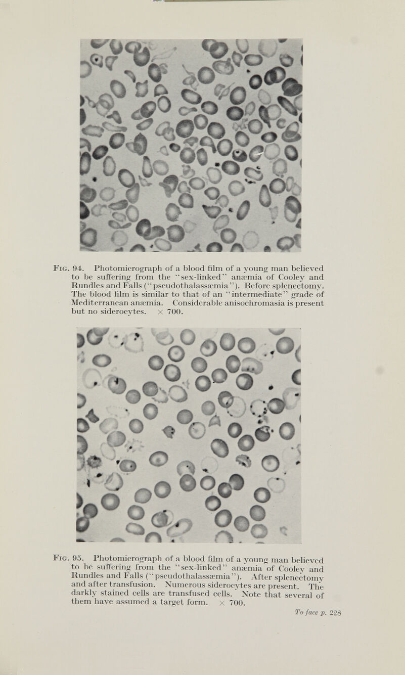 Fig. 94. Photomicrograph of a blood film of a young man believed to be suffering from the sex-linked anaemia of Cooley and Rundles and Falls (“ pseudothalassaemia”). Before splenectomy. The blood film is similar to that of an intermediate” grade of Mediterranean anaemia. Considerable anisochromasia is present but no siderocytes. x 700. ft* rp£)^ 0 ;^b/ ° ° ’•fid K ) Q O / 0 n ° ♦ ©1 cuè o * O 'o . J& 5 > y Fig. 95. Photomicrograph of a blood film of a young man believed to be suffering from the sex-linked” anaemia of Cooley and Rundles and Falls (pseudothalassaemia”). After splenectomy and after transfusion. Numerous siderocytes are present. The darkly stained cells are transfused cells. Note that several of them have assumed a target form, x 700. To face p. 228