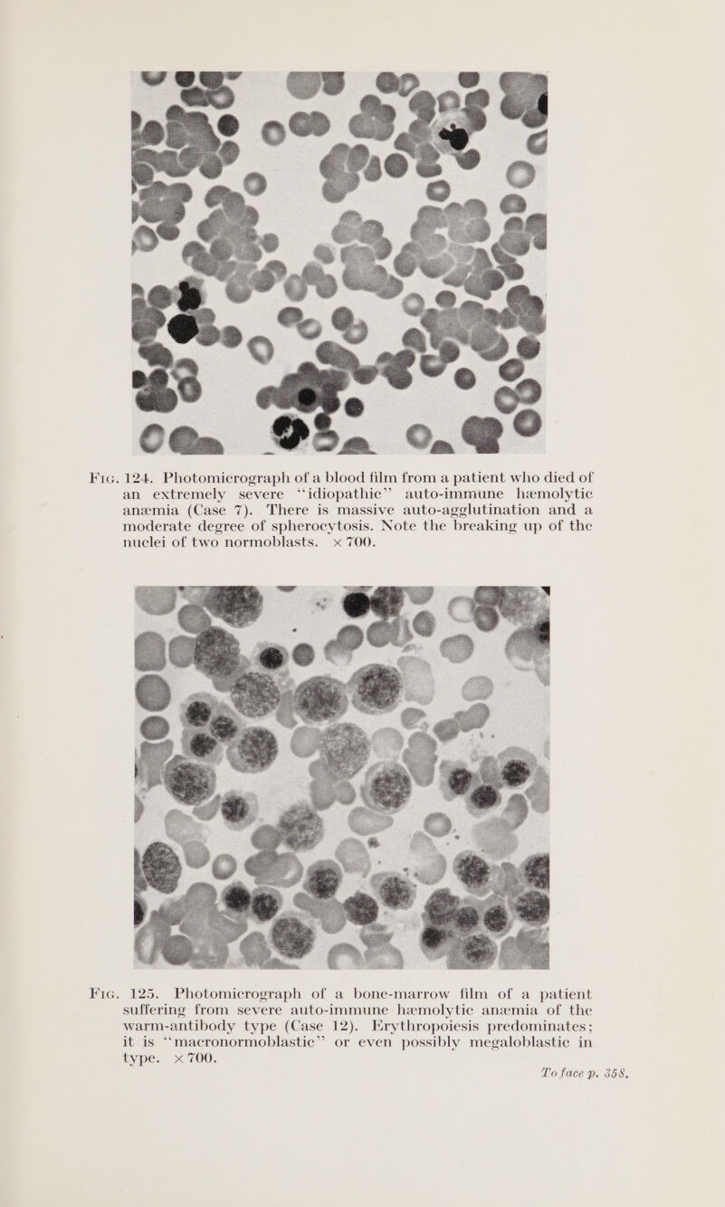 Fic. 124. Photomicrograph of a blood film from a patient who died of an extremely severe “idiopathic”? auto-immune hemolytic anemia (Case 7). There is massive auto-agglutination and a moderate degree of spherocytosis. Note the breaking up of the nuclei of two normoblasts. x 700. Fic. 125. Photomicrograph of a bone-marrow film of a patient suffering from severe auto-immune hemolytic anemia of the warm-antibody type (Case 12). Erythropoiesis predominates; it is “‘macronormoblastic’’ or even possibly megaloblastic in type. x 700.