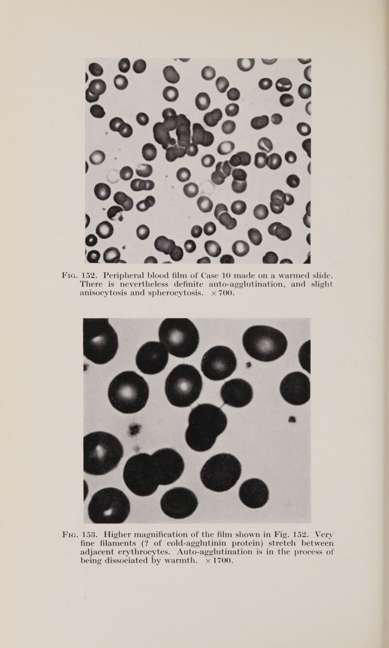 Fic. 158. Higher magnification of the film shown in Fig. 152. Very fine filaments (? of cold-agglutinin protein) stretch between adjacent erythrocytes. Auto-agglutination is in the process of being dissociated by warmth. x 1700.