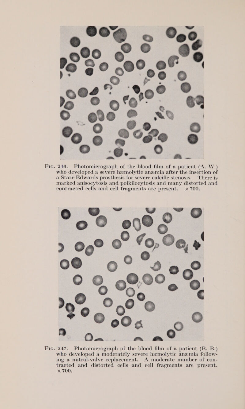 Fic. 246. Photomicrograph of the blood film of a patient (A. W.) who developed a severe hemolytic anzemia after the insertion of a Starr-Edwards prosthesis for severe calcific stenosis. There is marked anisocytosis and poikilocytosis and many distorted and contracted cells and cell fragments are present. x 700. Fic. 247. Photomicrograph of the blood film of a patient (B. B.) who developed a moderately severe hemolytic anemia follow- ing a mitral-valve replacement. A moderate number of con- tracted and distorted cells and cell fragments are present. x 700.