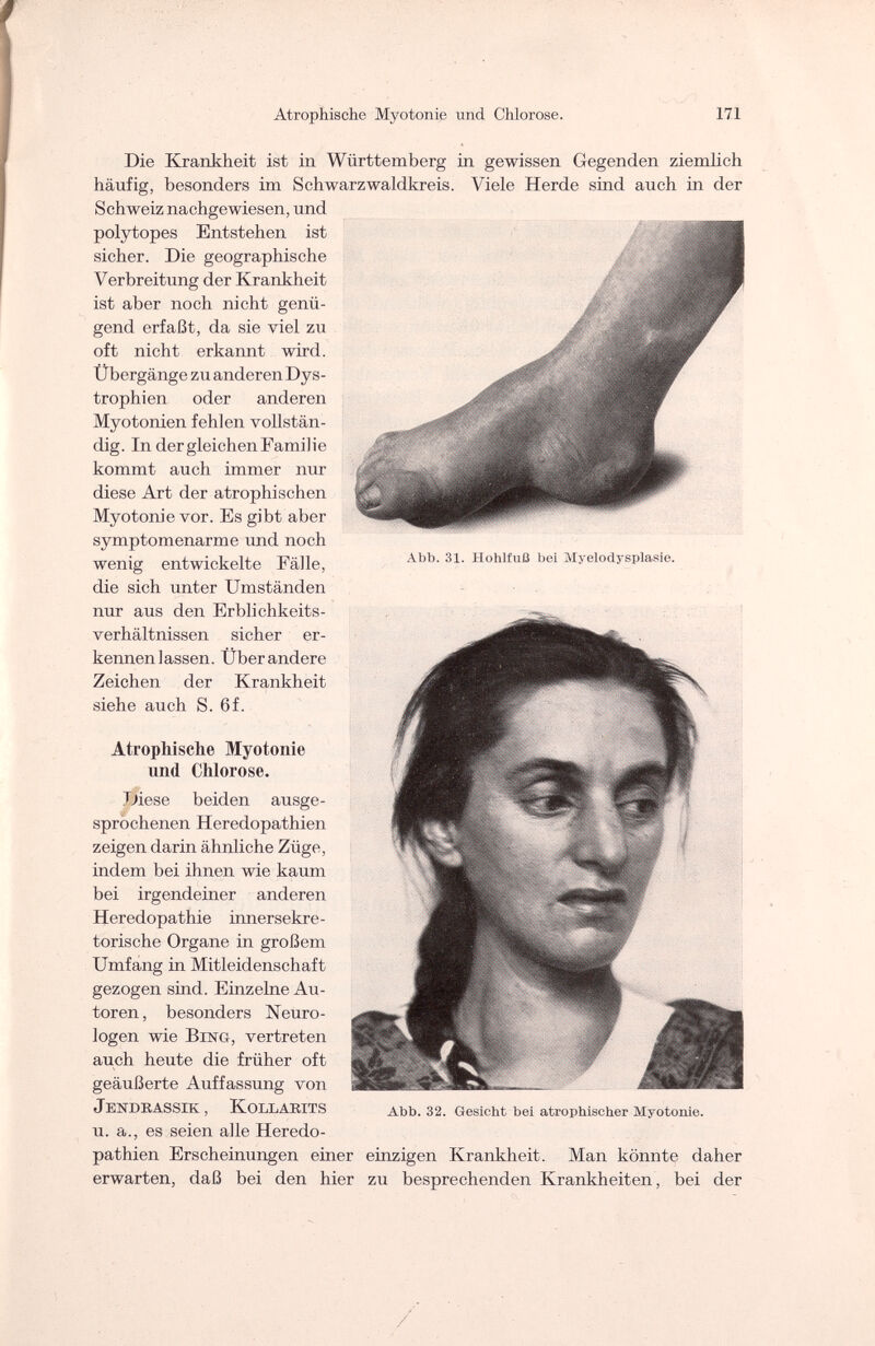 Atrophische Myotonie und Chlorose. 171 Abb. 31. Hohlfuß bei Myelodysplasie. Die Krankheit ist in Württemberg in gewissen Gegenden ziemlich häufig, besonders im Schwarzwaldkreis. Viele Herde sind auch in der Schweiz nachgewiesen, und polytopes Entstehen ist sicher. Die geographische Verbreitung der Krankheit ist aber noch nicht genü¬ gend erfaßt, da sie viel zu oft nicht erkannt wird. Übergänge zu anderen Dys¬ trophien oder anderen Myotonien fehlen vollstän¬ dig. In dergleichenFamilie kommt auch immer nur diese Art der atrophischen Myotonie vor. Es gibt aber symptomenarme und noch wenig entwickelte Fälle, die sich unter Umständen nur aus den Erblichkeits¬ verhältnissen sicher er¬ kennenlassen. Überandere Zeichen der Krankheit siehe auch S. 6f. Atrophische Myotonie und Chlorose. Diese beiden ausge¬ sprochenen Heredopathien zeigen darin ähnliche Züge, indem bei ihnen wie kaum bei irgendeiner anderen Heredopathie innersekre¬ torische Organe in großem Umfang in Mitleidenschaft gezogen sind. Einzelne Au¬ toren, besonders Neuro¬ logen wie Bing, vertreten auch heute die früher oft geäußerte Auffassung von JeNDRASSUv , KoLLARITS u. a., es seien alle Heredo¬ pathien Erscheinungen einer einzigen Krankheit. Man könnte daher erwarten, daß bei den hier zu besprechenden Krankheiten, bei der Abb. 32. Gesicht bei atrophischer Myotonie. /