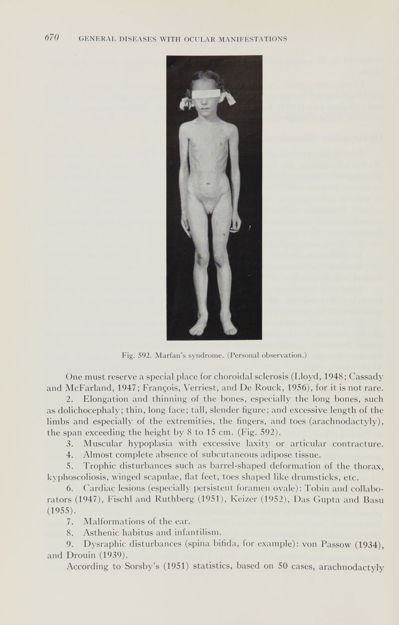 670 GENERAL DISEASES WITH OCULAR MANIFESTATIONS Fig. 592. Marian's syndrome. (Personal observation.) One must reserve a special place for choroidal sclerosis (Lloyd, 1948; Cassady and McFarland, 1947 ; François, Verriest, and De Rouck, 1956), for it is not rare. 2. Elongation and thinning of the bones, especially the long bones, such as dolichocephaly; thin, long face; tall, slender figure; and excessive length of the limbs and especially of the extremities, the fingers, and toes (arachnodactyly), the span exceeding the height by 8 to 15 cm. (Fig. 592). 3. Muscular hypoplasia with excessive laxity or articular contracture. 4. Almost complete absence of subcutaneous adipose tissue. 5. Trophic disturbances such as barrel-shaped deformation of the thorax, kyphoscoliosis, winged scapulae, flat feet, toes shaped like drumsticks, etc. 6. Cardiac lesions (especially persistent foramen ovale): Tobin and collabo¬ rators (1947), Fischi and Ruthberg (1951), Keizer (1952), Das Gupta and Basu (1955). 7. Malformations of the ear. 8. Asthenic habitus and infantilism. 9. Dysraphic disturbances (spina bifida, for example): von Passow (1934), and Drouin (1939). According to Sorsby's (1951) statistics, based on 50 cases, arachnodactyly