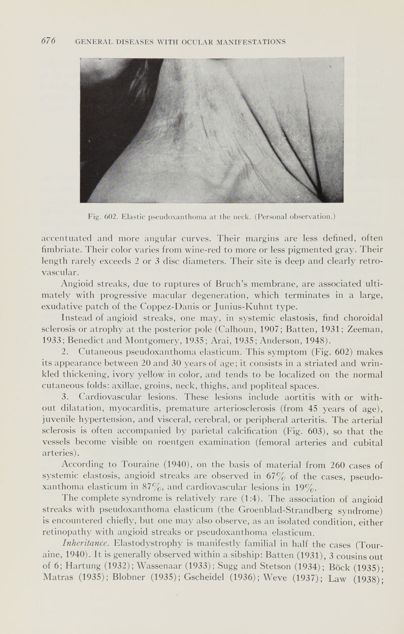 676 GENERAL DISEASES WITH OCULAR MANIFESTATIONS Fig. 602. Elastic pseudoxanthoma at the neck. (Personal observation.) accentuated and more angular curves. Their margins are less defined, often fimbriate. Their color varies from wine-red to more or less pigmented gray. Their length rarely exceeds 2 or 3 disc diameters. Their site is deep and clearly retro- vascular. Angioid streaks, due to ruptures of Bruch's membrane, are associated ulti¬ mately with progressive macular degeneration, which terminates in a large, exudative patch of the Coppez-Danis or Junius-Kuhnt type. Instead of angioid streaks, one may, in systemic elastosis, find choroidal sclerosis or atrophy at the posterior pole (Calhoun, 1907; Batten, 1931; Zeeman, 1933; Benedict and Montgomery, 1935; Arai, 1935; Anderson, 1948). 2. Cutaneous pseudoxanthoma elasticum. This symptom (Fig. 602) makes its appearance between 20 and 30 years of age; it consists in a striated and wrin¬ kled thickening, ivory yellow in color, and tends to be localized on the normal cutaneous folds: axillae, groins, neck, thighs, and popliteal spaces. 3. Cardiovascular lesions. These lesions include aortitis with or with¬ out dilatation, myocarditis, premature arteriosclerosis (from 45 years of age), juvenile hypertension, and visceral, cerebral, or peripheral arteritis. The arterial sclerosis is often accompanied by parietal calcification (Fig. 603), so that the vessels become visible on roentgen examination (femoral arteries and cubital arteries). According to Touraine (1940), on the basis of material from 260 cases of systemic elastosis, angioid streaks are observed in 67% of the cases, pseudo¬ xanthoma elasticum in 87%, and cardiovascular lesions in 19%. The complete syndrome is relatively rare (1:4). The association of angioid streaks with pseudoxanthoma elasticum (the Groenblad-Strandberg syndrome) is encountered chiefly, but one may also observe, as an isolated condition, either retinopathy with angioid streaks or pseudoxanthoma elasticum. Inheritance. Elastodystrophy is manifestly familial in half the cases (Tour¬ aine, 1940). It is generally observed within a sibship: Batten (1931), 3 cousins out of 6; Härtung (1932); Wassenaar (1933); Sugg and Stetson (1934); Bock (1935); Matras (1935) ; Blobner (1935) ; Gscheidel (1936); Weve (1937); Law (1938);