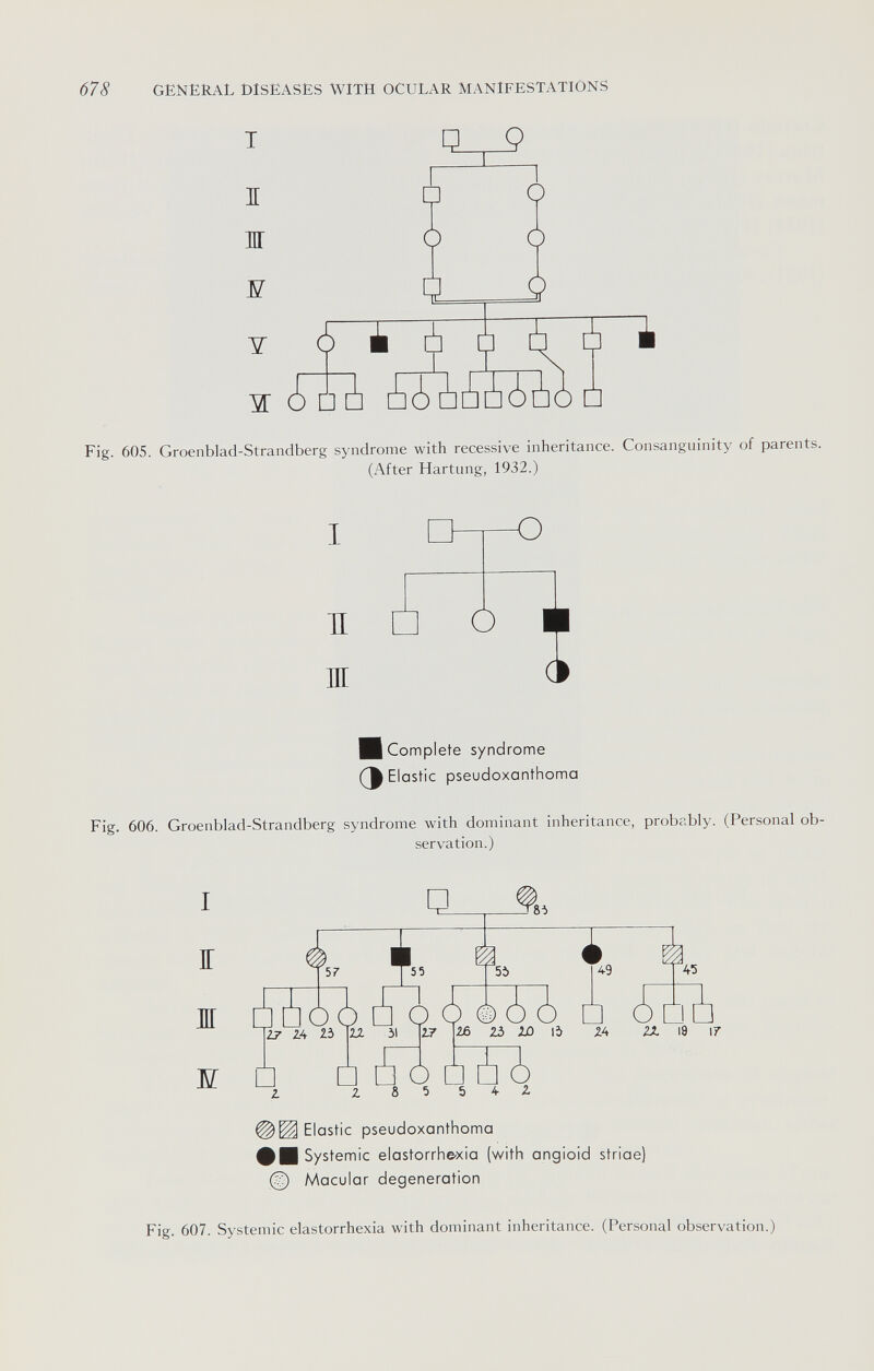 678 GENERAL DISEASES WITH OCULAR MANIFESTATIONS т I ж ¥ Y □ Ò 4 ó è à о о ж ? ¿ □ ¿ ¿l¿ ¿¿¿¿¿о □ Fig. 605. Groenblad-Strandberg syndrome with recessive inheritance. Consanguinity of parents. (After Härtung, 1932.) I H ж -о о t Complete syndrome Э Elastic pseudoxanthoma Fig. 606. Groenblad-Strandberg syndrome with dominant inheritance, probably. (Personal ob¬ servation.) I IT ж ж 57 55 ¿7 ¿4 23 О □ Z в 5 Ь А- Z ¿¿¿ [JO ¿ è ¿ ¿ □ ¿ ¿¿1 49 45 2ß ZÒ Ю \ò ZA 18 ir Elastic pseudoxanthoma m Systemic elastorrhe-xia (with angioid striae) (^ Macular degeneration Fig. 607. Systemic elastorrhexia with dominant inheritance. (Personal observation.)