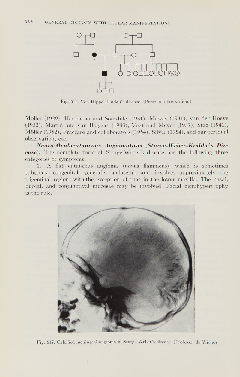 688 GENERAL DISEASES WITH OCULAR MANIFESTATIONS 0-Г-П □ o- -o Í Ò OÔÛQOCJOÛ0© OD Fig. 616. Von Hippel-Lindau's disease. (Personal observation.) Möller (1929), Hartmann and Sourdille (1931), Mawas (1931), van der Hoeve (1932), Martin and van Bogaert (1933), Vogt and Meyer (1937), Staz (1941), Möller (1952), Fraccaro and collaborators (1954), Silver (1954), and our personal observation, etc. Neuro-Oculocutaneous Angiomatosis (Sturge-Weber-Krabbe's Dis¬ ease). The complete form of Sturge-Weber's disease has the following three categories of symptoms: 1. A flat cutaneous angioma (nevus ñammeus), which is sometimes tuberous, congenital, generally unilateral, and involves approximately the trigeminal region, with the exception of that in the lower maxilla. The nasal, buccal, and conjunctival mucosae may be involved. Facial hemihypertrophy is the rule. Fig. 617. Calcified meningeal angioma in Sturge-Weber's disease. (Professor de Witte.)