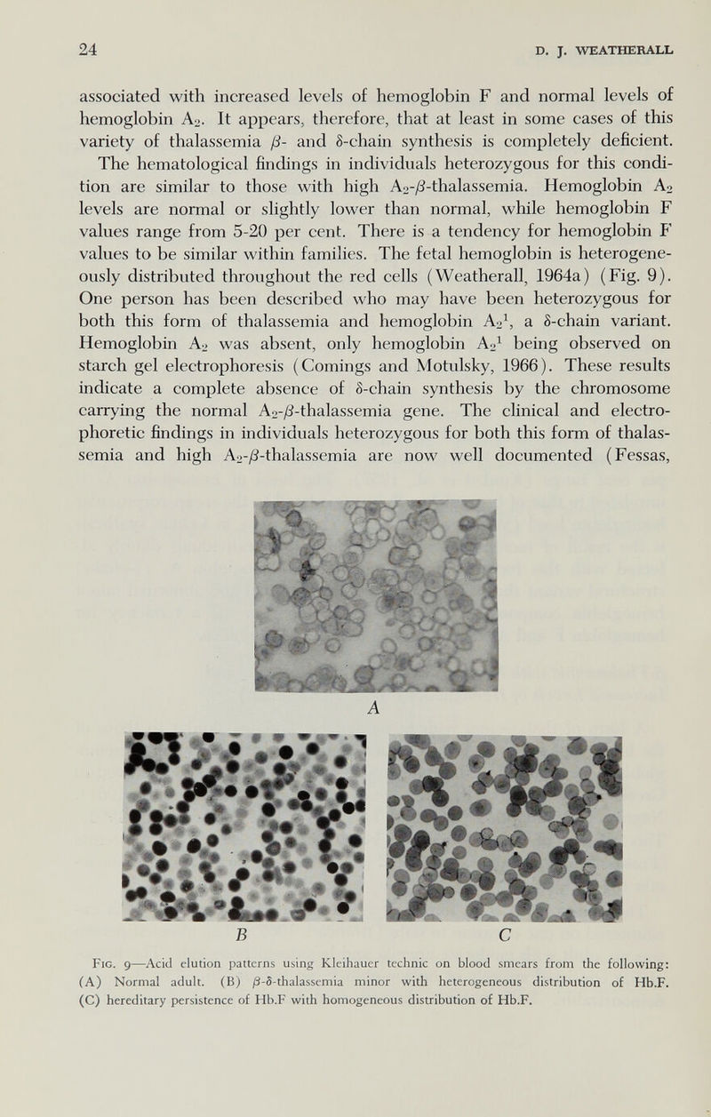 24 D, J. WEATHERALL associated with increased levels of hemoglobin F and normal levels of hemoglobin A2. It appears, therefore, that at least in some cases of this variety of thalassemia ß- and 8-chain synthesis is completely deficient. The hematological findings in individuals heterozygous for this condi¬ tion are similar to those with high Ao-^-thalassemia. Hemoglobin A2 levels are normal or slightly lower than normal, while hemoglobin F values range from 5-20 per cent. There is a tendency for hemoglobin F values to be similar within families. The fetal hemoglobin is heterogene- ously distributed throughout the red cells (Weatherall, 1964a) (Fig. 9). One person has been described who may have been heterozygous for both this form of thalassemia and hemoglobin a S-chain variant. Hemoglobin A^ was absent, only hemoglobin Аз^ being observed on starch gel electrophoresis (Comings and Motulsky, 1966). These results indicate a complete absence of S-chain synthesis by the chromosome carrying the normal Ao-yS-thalassemia gene. The clinical and electro- phoretic findings in individuals heterozygous for both this form of thalas¬ semia and high Ao-^S-thalassemia are now well documented (Fessas, Fig. 9—Acid elution patterns using Kleihauer technic on blood smears from the following: (A) Normal adult. (B) /З-5-thalassemia minor with heterogeneous distribution of Hb.F. (C) hereditary persistence of Hb.F with homogeneous distribution of Hb.F.