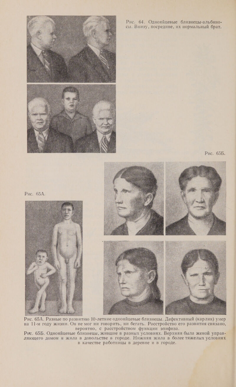 Рис. 64. Однояйцевые близнецы-альбино- сы. Внизу, посредине, их нормальный брат. Рис. 65А. Рис. 65А. Разные по развитию 10-летние однояйцевые близнецы. Дефективный (карлик) умер на 11-м году жизни. Он не мог ни говорить, ни бегать. Расстройство его развития связано, вероятно, с расстройством функции эпифиза. 1 Рис. 65Б. Однояйцевые близнецы, жившие в разных условиях. Верхняя была женой управ- ляющего домом и жила в довольстве в городе. Нижняя жила в более тяжелых условиях в качестве работницы в деревне и в городе.