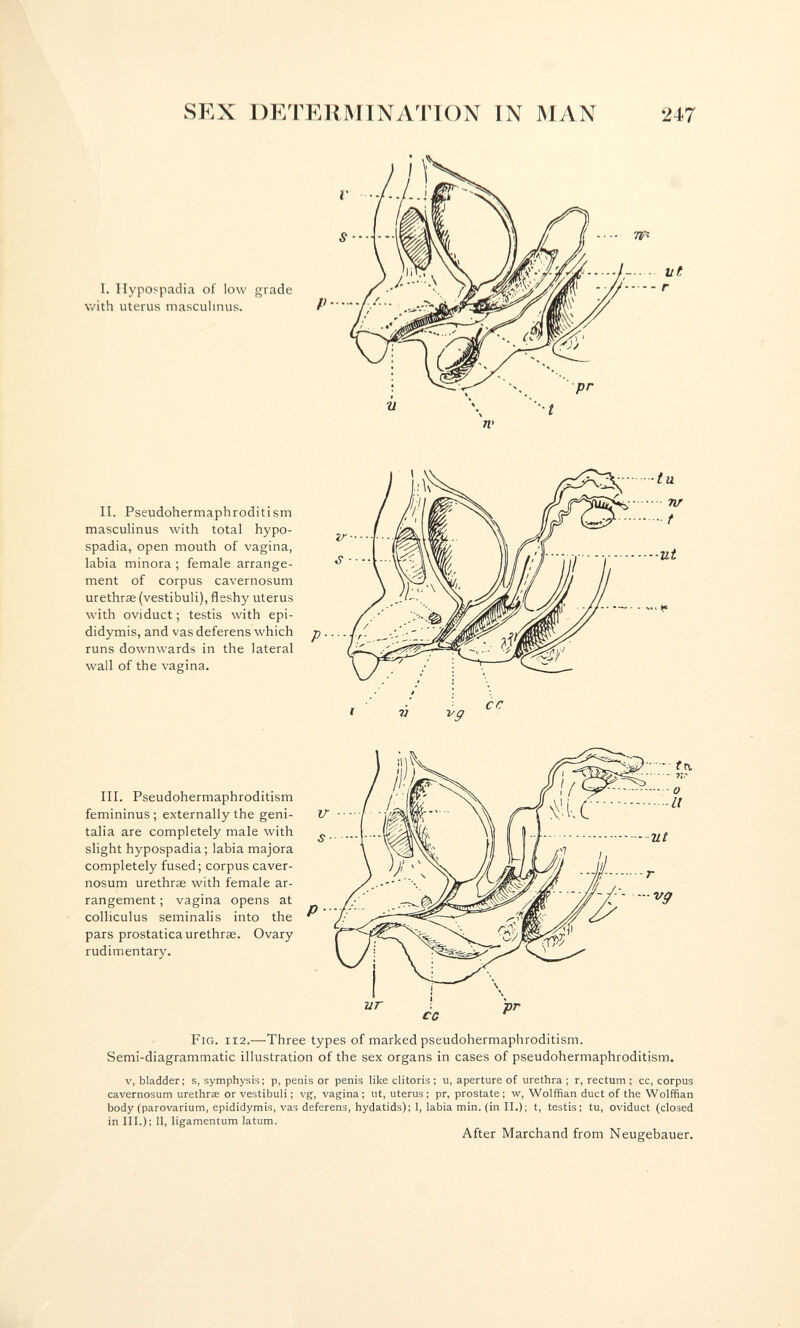 SEX DETEMÍINATION IN MAN 247 I. Hypospadia of low grade with uterus mascuhnus. /' П. Pseudohermaphroditism masculinus with total hypo¬ spadia, open mouth of vagina, labia minora ; female arrange¬ ment of corpus cavernosum urethrse (vestibuli), fleshy uterus with oviduct; testis with epi¬ didymis, and vas deferens which runs downwards in the lateral wail of the vagina. III. Pseudohermaphroditism femininus; externally the geni¬ talia are completely male with slight hypospadia; labia majora completely fused; corpus caver¬ nosum urethras with female ar¬ rangement ; vagina opens at colliculus seminalis into the pars prostatica urethrae. Ovary rudimentary. Fig. 112.—Three types of marked pseudohermaphroditism. Semi-diagrammatic illustration of the sex organs in cases of pseudohermaphroditism. V, bladder; s, symphysis; p, penis or penis like clitoris ; u, aperture of urethra ; r, rectum ; cc, corpus cavernosum urethras or vestibuli ; vg, vagina ; ut, uterus ; pr, prostate ; w, Wolffian duct of the Wolffian body (parovarium, epididymis, vas deferens, hydatids); 1, labia min. (in II.); t, testis; tu, oviduct (closed in III.); 11, ligamentum latum. After Marchand from Neugebauer.