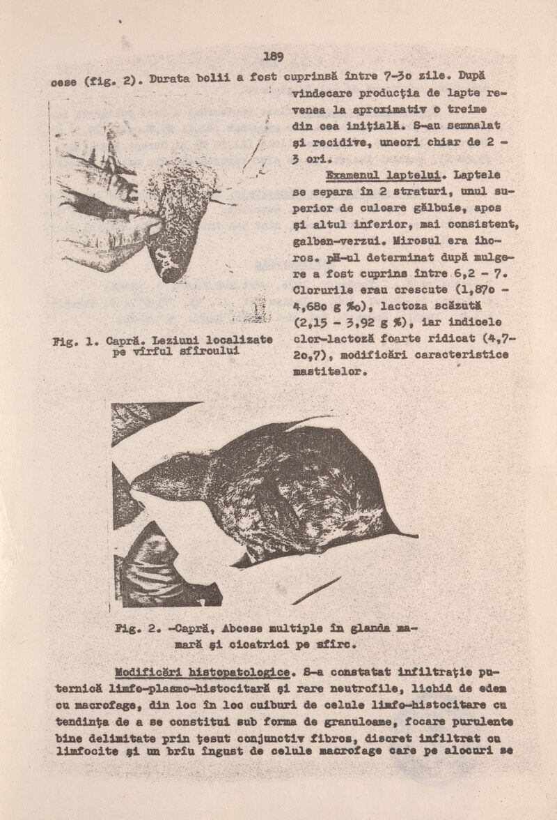 0«8в (fig* ■Г / 189 2)» Dorata bolli a fost с 1фг1ав& ìnfere 7-^o slle. Dupä rindecare producala de lapte re- ^ Tensa la aprozisafelT e trei&e din oea ini^ial&. S~aa eeamalat 9i recidlTe« oneorl chiar de 2 - 3 eri. Bxamenol laptelai« Laptele se separa in 2 Btratnri, шш1 sa- perior de calcare gfilbaie« apoa 9i aitai inferior, sai consistent galben-^rerzoi* Hirosul era ibe¬ ros. pB-ul detein&inat dupä molge» re a fost coprine ìntre 6,2 - ?• Clororile erau crescute (l,87o - 4,68o g %o)t lactoza 8cä£at& (2Д5 - 3»92 g %), iar indicele cloro-lactosfi fcarte ridicat (4,7- 2o,7), modificSri caracteristice saatitelor. - :-- Ш- ïlg, 1. Caprä. Xeziuni localízate pe vîrfol efîrcului fig. 2« --Caprä, АЪееае iialtiple în glanda ва— aarä щ± cicatriei i>e sfire. ' О Modificëri bistopatologjoe. S-a constatât infiltraci« pu- ^exnicä liafe^lasmo-bistocitarfi çi rare neatrofile, liobid de «des ca nacrofage, din loe în loo colbori de celai* llafo~histocitare ca tendinea de a se constitai ваЪ forma de granaloesie, focare purulente bine delimitate prin ^esat conjnnctiT fibros, discret infiltrât ca linfocite 9i on brîu îngost de celule macxofag« care pe alocar! м