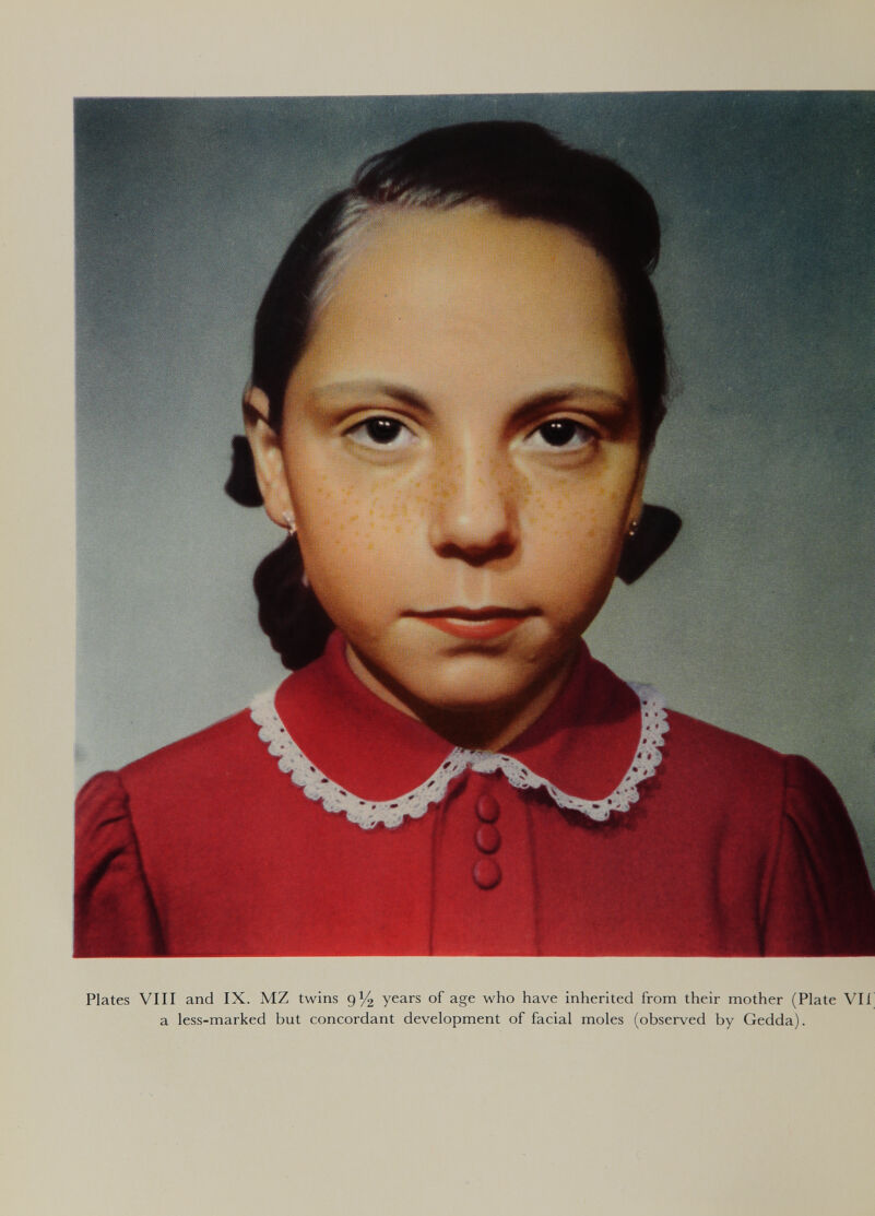 Plates Vili and IX. MZ twins 9^ years of age who have inherited from their mother (Plate Vii a less-marked but concordant development of facial moles (observed by Gedda).