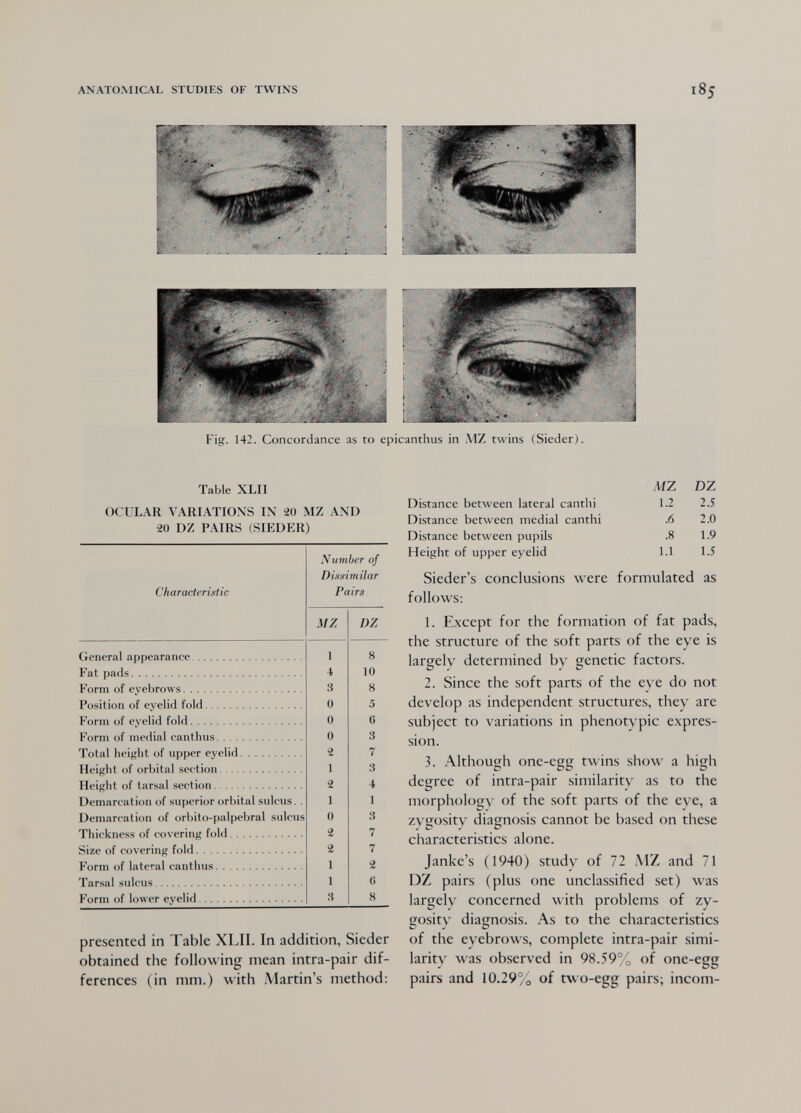 ANATOMICAL STUDIES OF TWINS Fig. 142. Concordance as to epicanthus in M7. twins (Sieder). Table XLII OCULAR VARIATIONS IN 20 MZ AND 20 DZ PAIRS (SIEÜER) presented in Table XLII. In addition, Sieder obtained the following mean intra-pair dif¬ ferences (in mm.) with Martin's method: MZ DZ Distance between lateral cantili 1.2 2.5 Distance between medial canthi .6 2.0 Distance between pupils .8 1.9 Height of upper eyelid 1.1 1.5 Sieder's conclusions were formulated as follows: 1. Except for the formation of fat pads, the structure of the soft parts of the eye is largely determined by genetic factors. 2. Since the soft parts of the eye do not develop as independent structures, they are subject to variations in phenotypic expres¬ sion. 3. Although one-egg twins show a high degree of intra-pair similarity as to the morpholog\- of the soft parts of the eye, a zygosity diagnosis cannot be based on these characteristics alone. Janke's (1940) study of 72 MZ and 71 DZ pairs (plus one unclassified set) was largely concerned with problems of zy¬ gosity diagnosis. As to the characteristics of the eyebrows, complete intra-pair simi¬ larity was observed in 98.59% of one-egg pairs and 10.29% of two-egg pairs; incom-