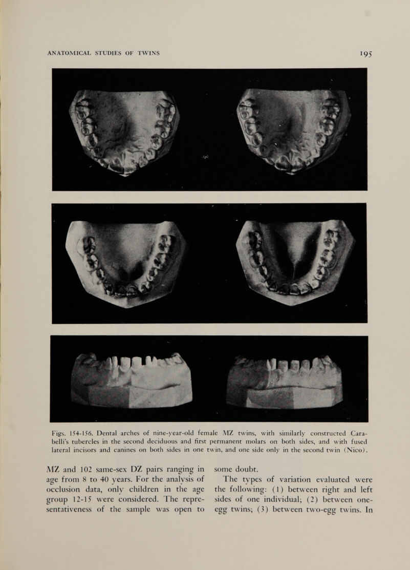ANATOMICAL STUDIES OF TWINS 195 v Figs. 154-156. Dental arches of nine-year-old female MZ twins, with similarly constructed Cara- belli's tubercles in the second deciduous and first permanent molars on both sides, and with fused lateral incisors and canines on both sides in one twin, and one side only in the second twin (Nico). MZ and 102 same-sex DZ pairs ranging in age from 8 to 40 years. For the analysis of occlusion data, onlv children in the age group 12-15 were considered. The repre¬ sentativeness of the sample was open to some doubt. The types of variation evaluated were the following: (1) between right and left sides of one individual; (2) between one- egg twins; (3) between two-egg twins. In