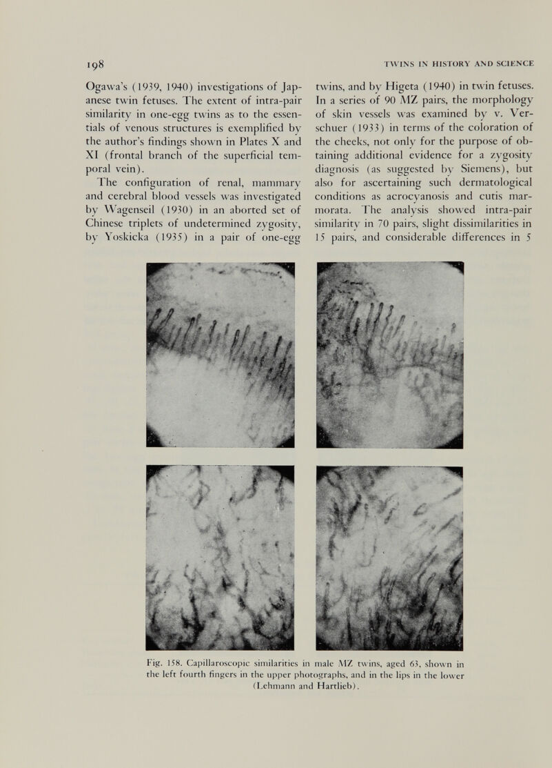 198 TWINS IN HISTORY AND SCIENCE Ogawa's (1939, 1940) investigations of Jap¬ anese twin fetuses. The extent of intra-pair similarity in one-egg twins as to the essen¬ tials of venous structures is exemplified by the author's findings shown in Plates X and XI (frontal branch of the superficial tem¬ poral vein). The configuration of renal, mammary and cerebral blood vessels was investigated by Wagenseil (1930) in an aborted set of Chinese triplets of undetermined zygosity, by Yoskicka (1935) in a pair of one-egg twins, and by Higeta (1940) in twin fetuses. In a series of 90 MZ pairs, the morphology of skin vessels was examined by v. Ver- schuer ( 1933) in terms of the coloration of the cheeks, not only for the purpose of ob¬ taining additional evidence for a zygosity diagnosis (as suggested by Siemens), but also for ascertaining such dermatological conditions as acrocyanosis and cutis mar- morata. The analysis showed intra-pair similarity in 70 pairs, slight dissimilarities in 15 pairs, and considerable differences in 5 Fig. 158. Capillaroscopic similarities in male MZ twins, aged 63, shown in the left fourth fingers in the upper photographs, and in the lips in the lower (Lehmann and Hartlieb).