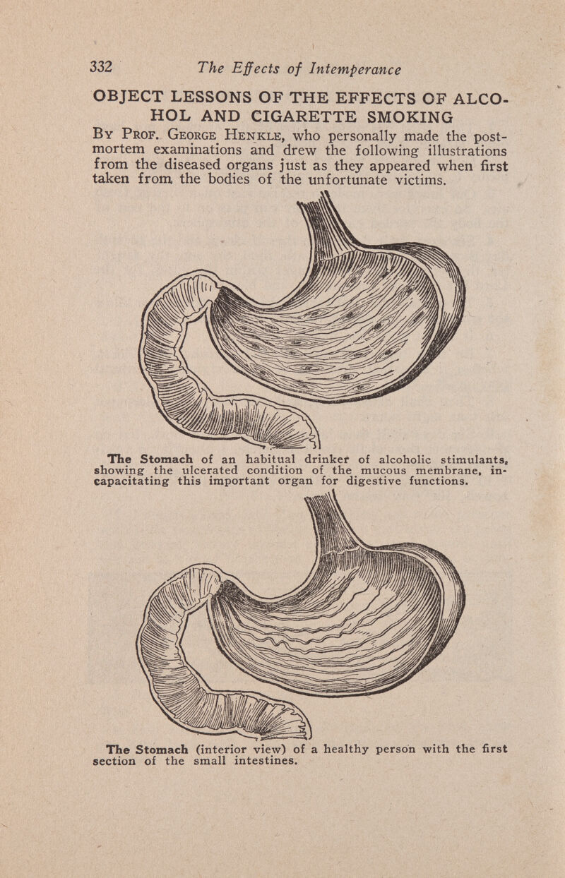 332 The Effects of Intemperance OBJECT LESSONS OF THE EFFECTS OF ALCO¬ HOL AND CIGARETTE SMOKING By Prof. George Henkle, who personally made the post¬ mortem examinations and drew the following illustrations from the diseased organs just as they appeared when first taken from the bodies of the unfortunate victims. The Stomach of an habitual drinkei of alcoholic stimulants, showing the ulcerated condition of the mucous membrane, in¬ capacitating this important organ for digestive functions. section of the small intestines.