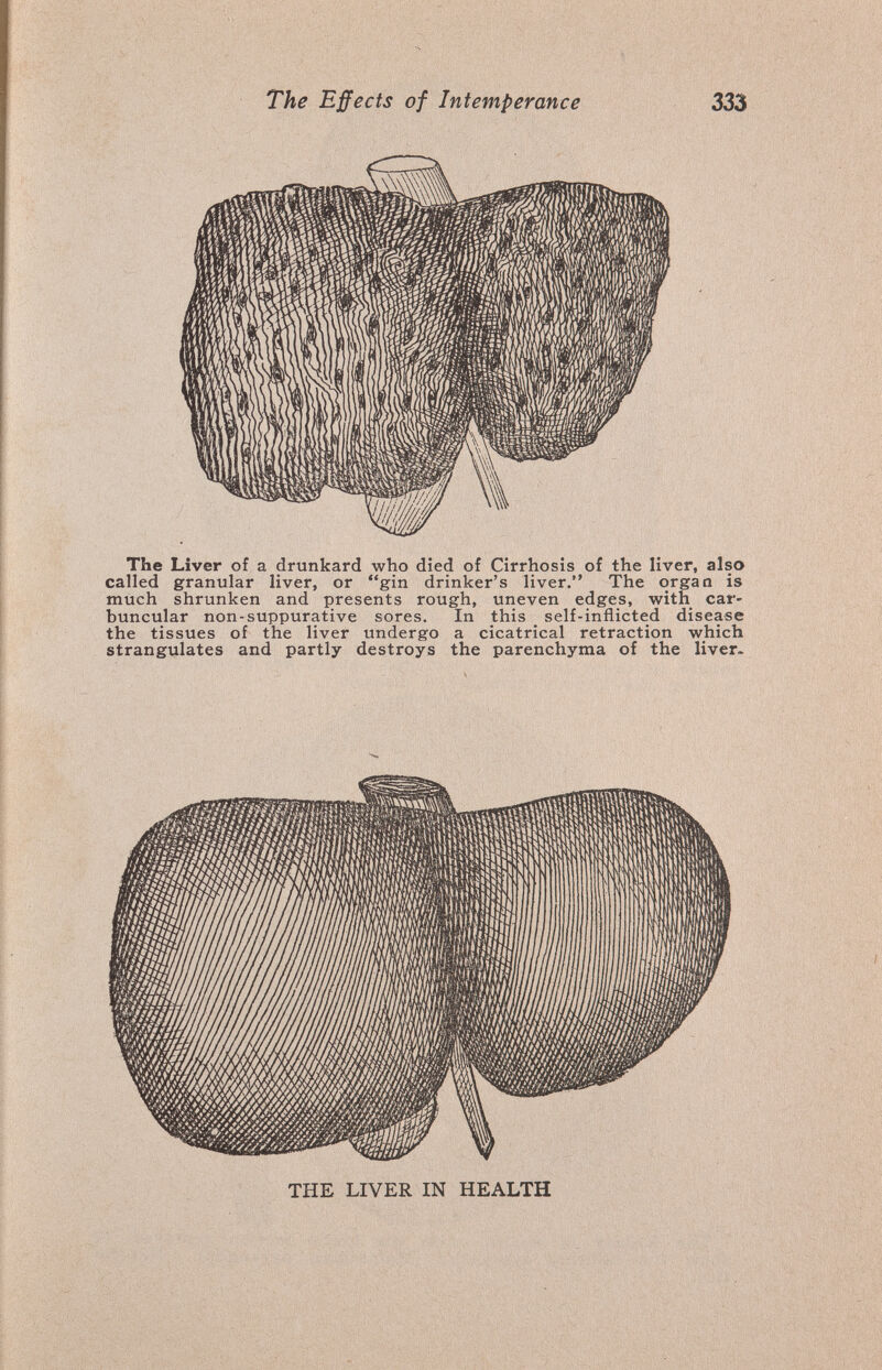 The Effects of Intemperance 333 The Liver of a drunkard who dîed of Cirrhosis of the liver, also called granular liver, or gin drinker's liver. The organ is much shrunken and presents rough, uneven edges, with car- buncular non-suppurative sores. In this _ self-inflicted disease the tissues of the liver undergo a cicatrical retraction which strangulates and partly destroys the parenchyma of the liver. THE LIVER IN HEALTH