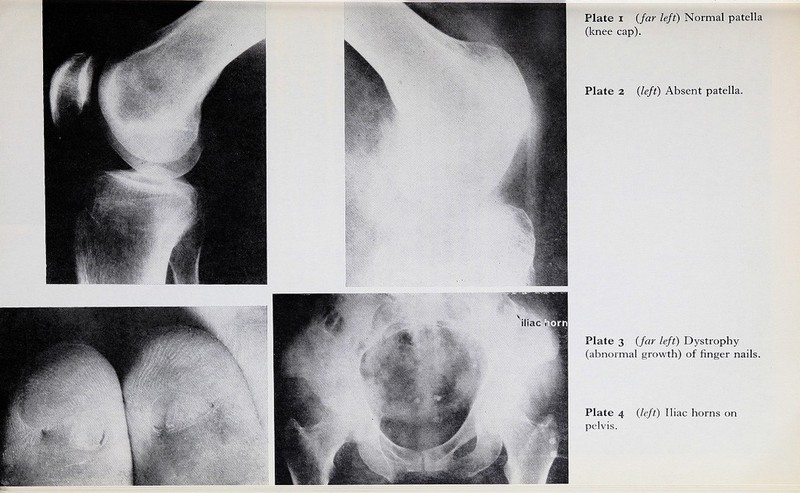 Plate I (far left) Normal patella (knee cap). Plate 2 (left) Absent patella. Plate 3 (far left) Dystrophy (abnormal growth) of finger nails. Plate 4 (left) Iliac horns on