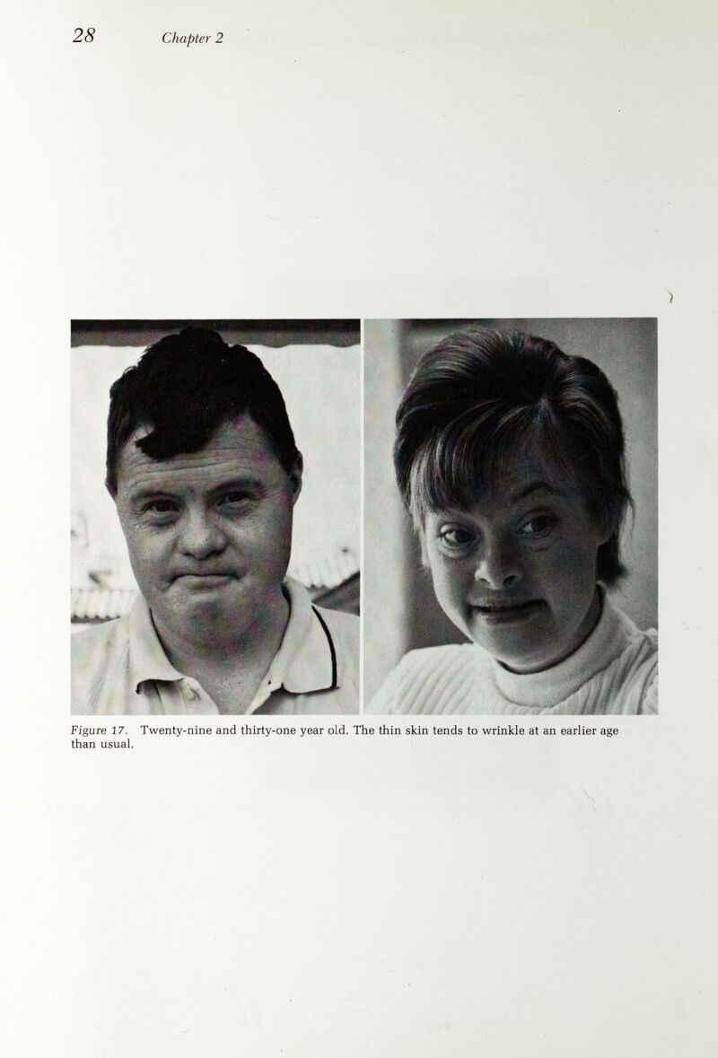 Chapter 2 Muscle Tone: Babies with Down's syndrome have less muscle tone (hypotonia) and therefore tend to be a bit floppy and loose-jointed. This improves with age and is seldom a problem. Head: The back of the head (occiput) may appear less prominent than usual, and the head tends to be a bit smaller than average. The soft spots (fontanels) may be large and later in closing than usual. Nose: The nose tends to be small, and the bridge of the nose some¬ what low, so that, from a profile angle, the face appears relatively flat. Eyes: The eyes tend to slant upward (slanting palpebral fissures). There may be small folds of skin at the inside corners of the eyes (inner canthal folds). These folds, which occasionally occur in normal babies, tend to become less prominent in later childhood. The outer portion of th^e iris of the eye may be speckled with lightly colored spots (Brushfield spots), especially noticeable in blue-eyed babies. Ears; The ears are usually small, and sometimes prominent. The top rim of the ear (helix) is frequently folded over slightly. The ear lobes may be quite small. Mouth: Although the tongue is of normal size, the mouth may be relatively small and the roof of the mouth a bit short; for this reason and because of generally poor muscle tone, the tongue of a baby with Down's syndrome may intermittently protrude. In older children with Down's syndrome a furrowed tongue sometimes develops. Their lips chap very easily out-of-doors. Teeth: The teeth may be a bit small, and sometimes are abnormally shaped. They may come in late and occasionally are placed in an unusual position. Sometimes one or more teeth are missing. Children with Down's syndrome tend to have fewer cavities than other children. As they get older, they may have trouble with their gums, usually because the gums become inflamed or begin to recede. This may sometimes lead to loss of teeth in late childhood or early adulthood and is not necessarily due to poor oral hygiene. Voice: The voice may have a slightly deep quality in early to late childhood. Onset of speech is generally late, and learning to talk articu¬ lately is generally difficult for Down's syndrome children. Some families have found that after their child has begun to talk, speech therapy can be of help if he is having difficulties in pronunciation and speech develop¬ ment. Neck: The neck frequently appears a bit short. Babies with Down's syndrome may have loose folds of skin across the back of the neck which become less prominent with time. Heart: In about 40 per cent of children with Down's syndrome a defect in the development of the heart is detected at birth or shortly af¬ terward. In about half of these children the severity of the defect leads to an early death. The defects of heart development that may occur in Down's syndrome children are discussed in greater detail at the end of this chapter. Hands: The hands often appear small, with relatively short fingers. There may be a single crease across the upper palm instead of the more usual two. The fifth finger may be somewhat short and may have only a single crease on it. The tip of this finger frequently turns inward toward the other fingers (clinodactyly).