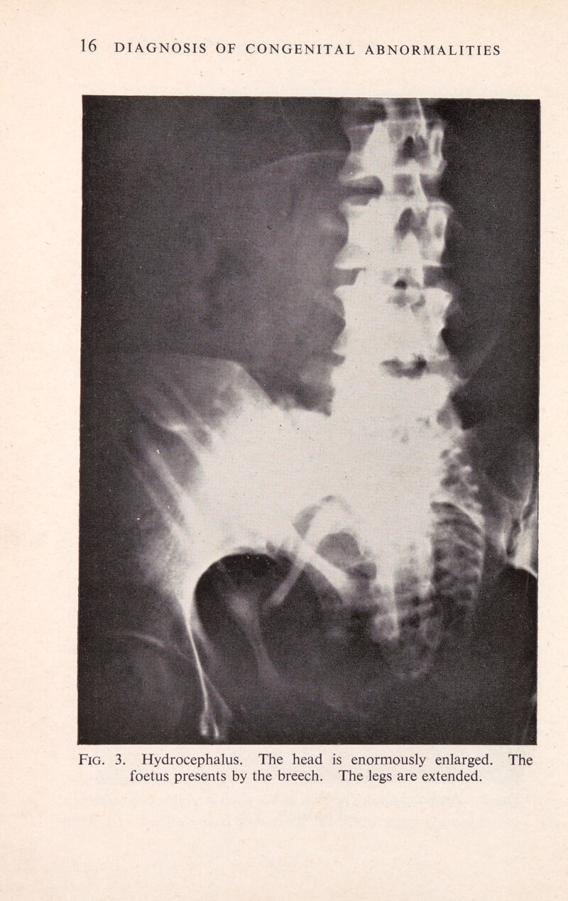 16 DIAGNOSIS OF CONGENITAL ABNORMALITIES Fig. 3. Hydrocephalus. The head is enormously enlarged. The foetus presents by the breech. The legs are extended.