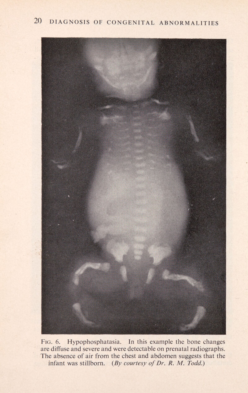 20 DIAGNOSIS OF CONGENITAL ABNORMALITIES Fig. 6. Hypophosphatasia. In this example the bone changes are diffuse and severe and were detectable on prenatal radiographs. The absence of air from the chest and abdomen suggests that the infant was stillborn. {By courtesy of Dr. R. M. Todd.)