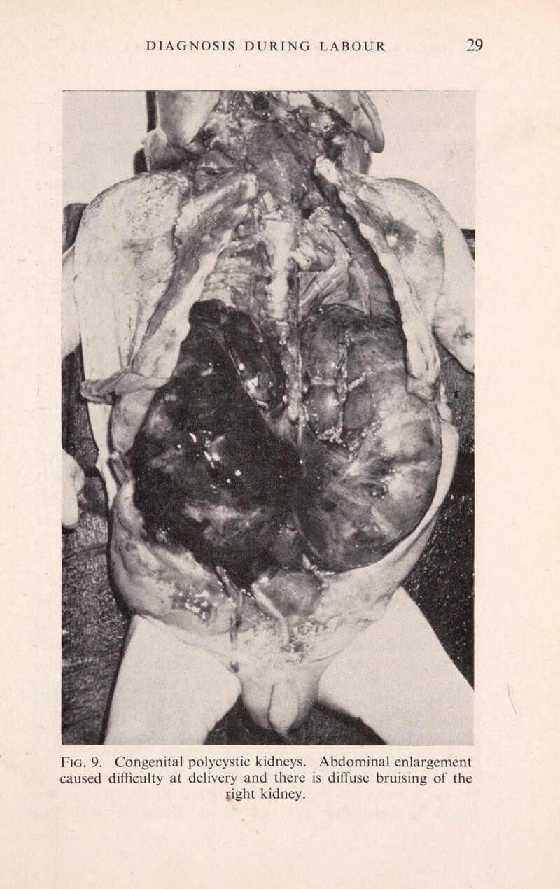 DIAGNOSIS DURING LABOUR 29 Fig. 9. Congenital polycystic kidneys. Abdominal enlargement caused difficulty at delivery and there is diffuse bruising of the light kidney.