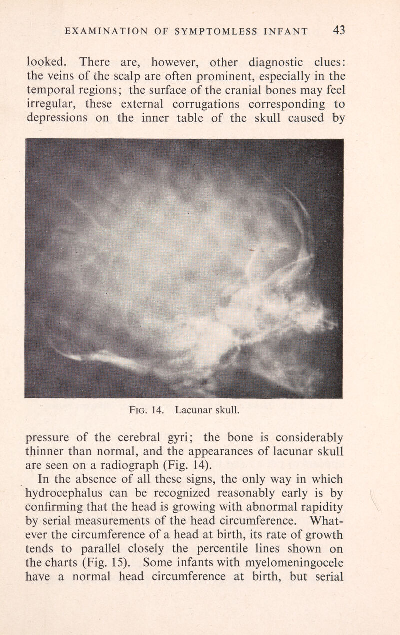 EXAMINATION OF SYMPTOMLESS INFANT 43 looked. There are, however, other diagnostic clues; the veins of the scalp are often prominent, especially in the temporal regions ; the surface of the cranial bones may feel irregular, these external corrugations corresponding to depressions on the inner table of the skull caused by Fig. 14. Lacunar skull. pressure of the cerebral gyri; the bone is considerably thinner than normal, and the appearances of lacunar skull are seen on a radiograph (Fig. 14). In the absence of all these signs, the only way in which hydrocephalus can be recognized reasonably early is by confirming that the head is growing with abnormal rapidity by serial measurements of the head circumference. What¬ ever the circumference of a head at birth, its rate of growth tends to parallel closely the percentile lines shown on the charts (Fig. 15). Some infants with myelomeningocele have a normal head circumference at birth, but serial