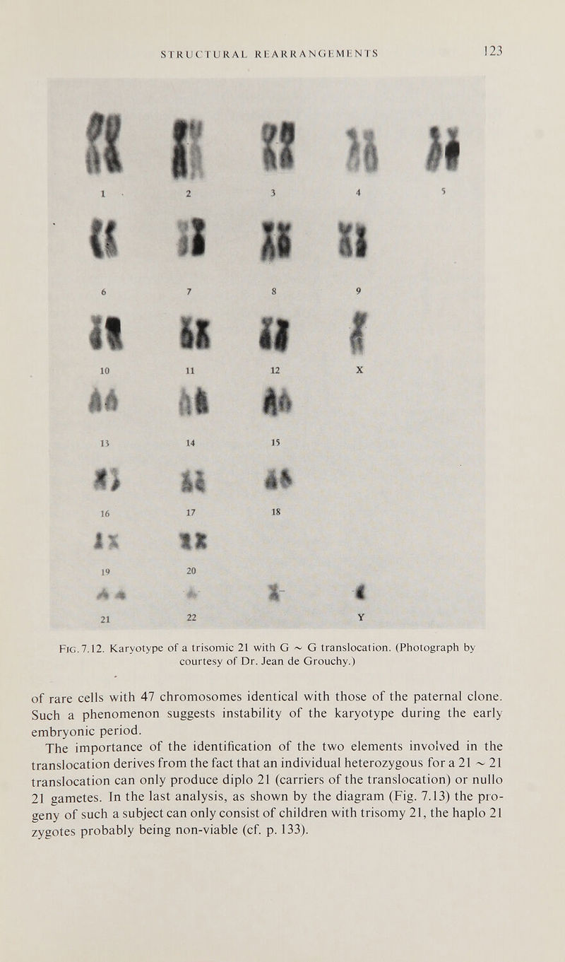 STRUCTURAL REARRANGЬMЬNTS 123 10 11 12 lì 14 IS 16 17 18 19 21 20 22 Fig. 7.12. Karyotype of a trisomie 21 with G ~ G translocation. (Photograph by courtesy of Dr. Jean de Grouchy.) of rare cells with 47 chromosomes identical with those of the paternal clone. Such a phenomenon suggests instability of the karyotype during the early embryonic period. The importance of the identification of the two elements involved in the translocation derives from the fact that an individual heterozygous for a 21 ~ 21 translocation can only produce diplo 21 (carriers of the translocation) or nullo 21 gametes. In the last analysis, as shown by the diagram (Fig. 7.13) the pro¬ geny of such a subject can only consist of children with trisomy 21, the haplo 21 zygotes probably being non-viable (cf. p. 133).