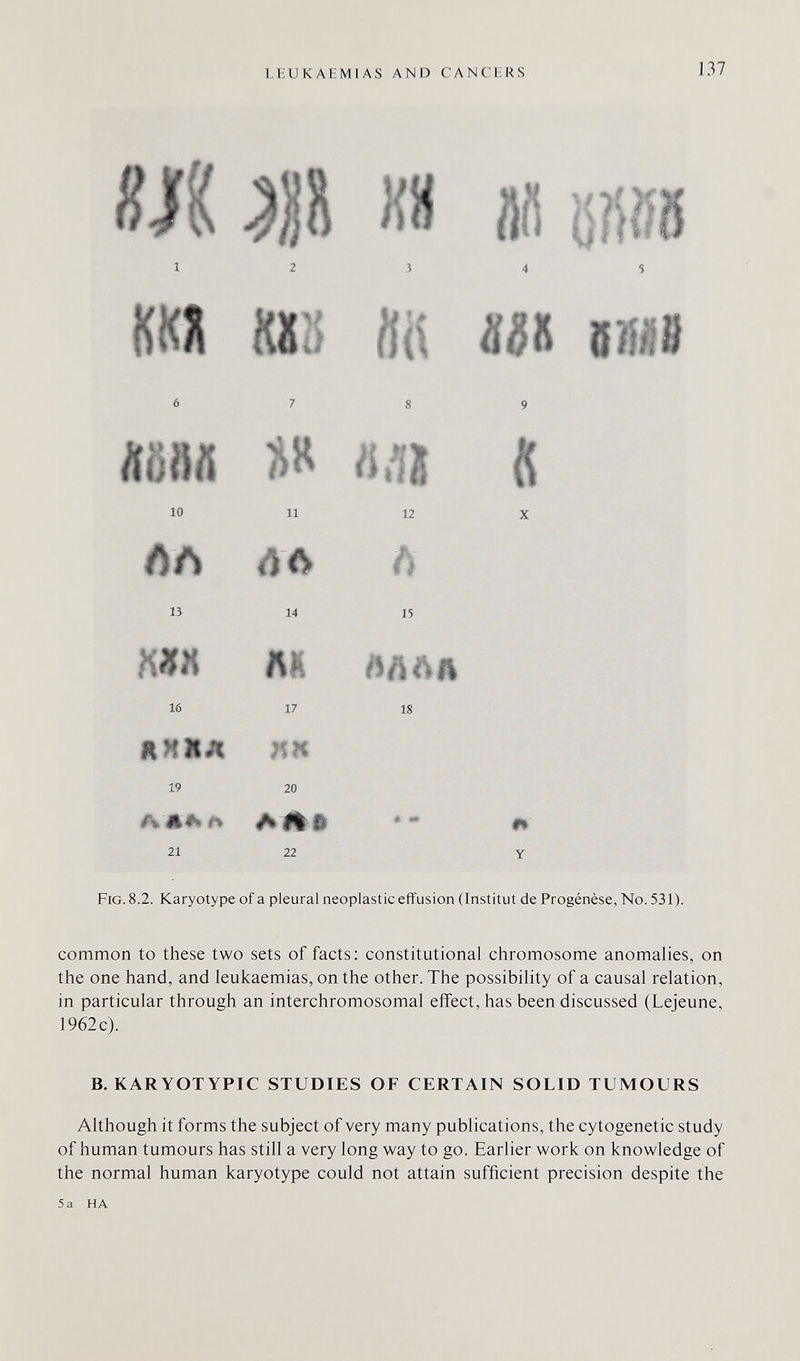 LEUKAEMIAS AND CANCERS 137 16 21 17 19 20 22 18 Fig. 8.2. Karyotype of a pleural neoplastic effusion (Institut de Progénèse, No. 531). common to these two sets of facts: constitutional chromosome anomalies, on the one hand, and leukaemias, on the other. The possibility of a causal relation, in particular through an interchromosomal effect, has been discussed (Lejeune, 1962 c). B. KARYOTYPIC STUDIES OF CERTAIN SOLID TUMOURS Although it forms the subject of very many publications, the cytogenetic study of human tumours has still a very long way to go. Earlier work on knowledge of the normal human karyotype could not attain sufficient precision despite the 5 a HA