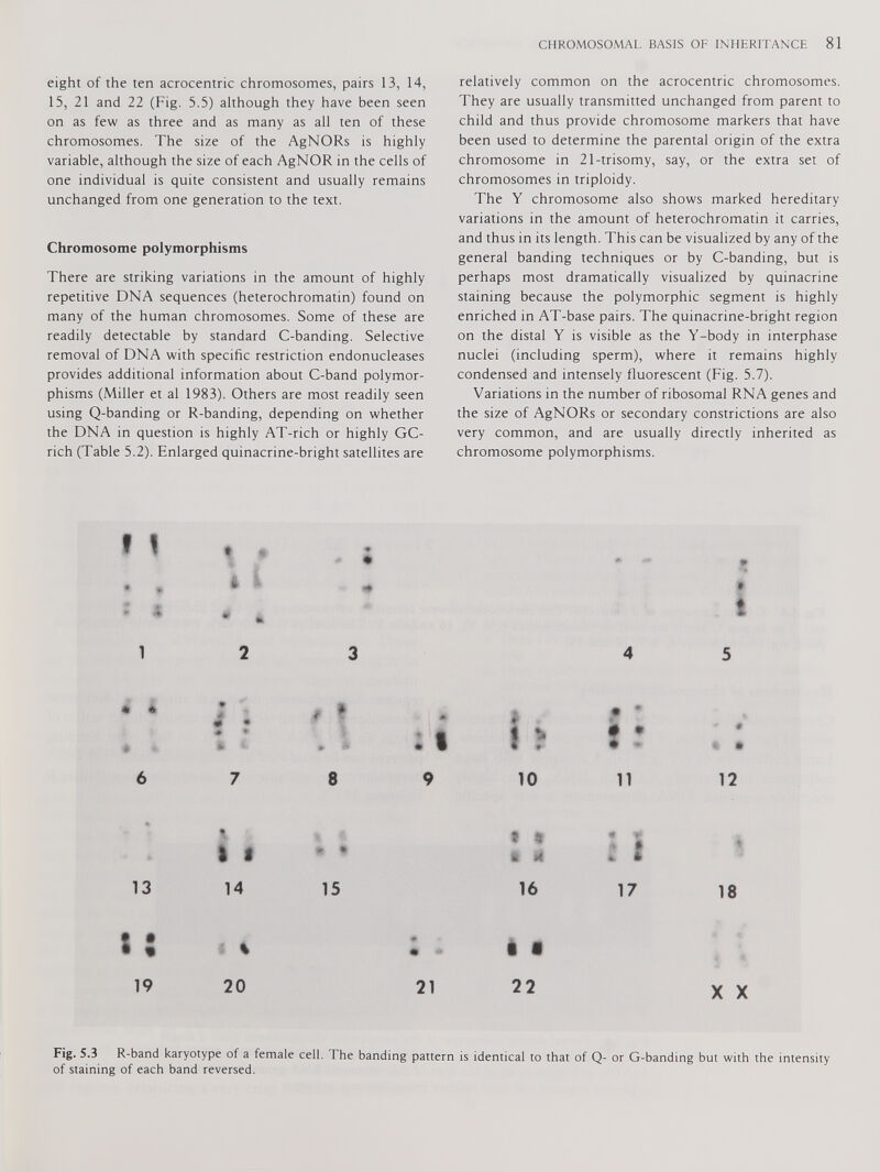 eight of the ten acrocentric chromosomes, pairs 13, 14, 15, 21 and 22 (Fig. 5.5) although they have been seen on as few as three and as many as all ten of these chromosomes. The size of the AgNORs is highly variable, although the size of each AgNOR in the cells of one individual is quite consistent and usually remains unchanged from one generation to the text. Chromosome polymorphisms There are striking variations in the amount of highly repetitive DNA sequences (heterochromatin) found on many of the human chromosomes. Some of these are readily detectable by standard C-banding. Selective removal of DNA with specific restriction endonucleases provides additional information about C-band polymor phisms (Miller et al 1983). Others are most readily seen using Q-banding or R-banding, depending on whether the DNA in question is highly AT-rich or highly GC- rich (Table 5.2). Enlarged quinacrine-bright satellites are relatively common on the acrocentric chromosomes. They are usually transmitted unchanged from parent to child and thus provide chromosome markers that have been used to determine the parental origin of the extra chromosome in 21-trisomy, say, or the extra set of chromosomes in triploidy. The Y chromosome also shows marked hereditary variations in the amount of heterochromatin it carries, and thus in its length. This can be visualized by any of the general banding techniques or by C-banding, but is perhaps most dramatically visualized by quinacrine staining because the polymorphic segment is highly enriched in AT-base pairs. The quinacrine-bright region on the distal Y is visible as the Y-body in interphase nuclei (including sperm), where it remains highly condensed and intensely fluorescent (Fig. 5.7). Variations in the number of ribosomal RNA genes and the size of AgNORs or secondary constrictions are also very common, and are usually directly inherited as chromosome polymorphisms. » 1 ♦ f 1 2 3 4 5 * * • * # * * - 6 7 8 9 10 11 12 If 13 14 15 t % * <4 16 18 l i 19 20 I • 21 22 X X Fig. 5.3 R-band karyotype of a female cell. The banding pattern is identical to that of Q- or G-banding but with the intensity of staining of each band reversed.