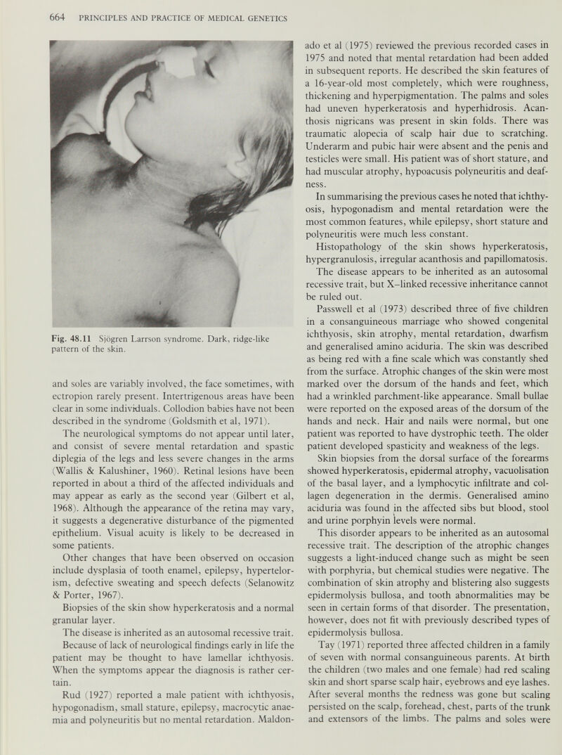 Fig. 48.11 Sjogren Larrson syndrome. Dark, ridge-like pattern of the skin. and soles are variably involved, the face sometimes, with ectropion rarely present. Intertrigenous areas have been clear in some individuals. Collodion babies have not been described in the syndrome (Goldsmith et al, 1971). The neurological symptoms do not appear until later, and consist of severe mental retardation and spastic diplegia of the legs and less severe changes in the arms (Wallis & Kalushiner, 1960). Retinal lesions have been reported in about a third of the affected individuals and may appear as early as the second year (Gilbert et al, 1968). Although the appearance of the retina may vary, it suggests a degenerative disturbance of the pigmented epithelium. Visual acuity is likely to be decreased in some patients. Other changes that have been observed on occasion include dysplasia of tooth enamel, epilepsy, hypertelor ism, defective sweating and speech defects (Selanowitz & Porter, 1967). Biopsies of the skin show hyperkeratosis and a normal granular layer. The disease is inherited as an autosomal recessive trait. Because of lack of neurological findings early in life the patient may be thought to have lamellar ichthyosis. When the symptoms appear the diagnosis is rather cer tain. Rud (1927) reported a male patient with ichthyosis, hypogonadism, small stature, epilepsy, macrocytic anae mia and polyneuritis but no mental retardation. Maldon ado et al (1975) reviewed the previous recorded cases in 1975 and noted that mental retardation had been added in subsequent reports. He described the skin features of a 16-year-old most completely, which were roughness, thickening and hyperpigmentation. The palms and soles had uneven hyperkeratosis and hyperhidrosis. Acan thosis nigricans was present in skin folds. There was traumatic alopecia of scalp hair due to scratching. Underarm and pubic hair were absent and the penis and testicles were small. His patient was of short stature, and had muscular atrophy, hypoacusis polyneuritis and deaf ness. In summarising the previous cases he noted that ichthy osis, hypogonadism and mental retardation were the most common features, while epilepsy, short stature and polyneuritis were much less constant. Histopathology of the skin shows hyperkeratosis, hypergranulosis, irregular acanthosis and papillomatosis. The disease appears to be inherited as an autosomal recessive trait, but X-linked recessive inheritance cannot be ruled out. Passwell et al (1973) described three of five children in a consanguineous marriage who showed congenital ichthyosis, skin atrophy, mental retardation, dwarfism and generalised amino aciduria. The skin was described as being red with a fine scale which was constantly shed from the surface. Atrophic changes of the skin were most marked over the dorsum of the hands and feet, which had a wrinkled parchment-like appearance. Small bullae were reported on the exposed areas of the dorsum of the hands and neck. Hair and nails were normal, but one patient was reported to have dystrophic teeth. The older patient developed spasticity and weakness of the legs. Skin biopsies from the dorsal surface of the forearms showed hyperkeratosis, epidermal atrophy, vacuolisation of the basal layer, and a lymphocytic infiltrate and col lagen degeneration in the dermis. Generalised amino aciduria was found in the affected sibs but blood, stool and urine porphyin levels were normal. This disorder appears to be inherited as an autosomal recessive trait. The description of the atrophic changes suggests a light-induced change such as might be seen with porphyria, but chemical studies were negative. The combination of skin atrophy and blistering also suggests epidermolysis bullosa, and tooth abnormalities may be seen in certain forms of that disorder. The presentation, however, does not fit with previously described types of epidermolysis bullosa. Tay (1971) reported three affected children in a family of seven with normal consanguineous parents. At birth the children (two males and one female) had red scaling skin and short sparse scalp hair, eyebrows and eye lashes. After several months the redness was gone but scaling persisted on the scalp, forehead, chest, parts of the trunk and extensors of the limbs. The palms and soles were