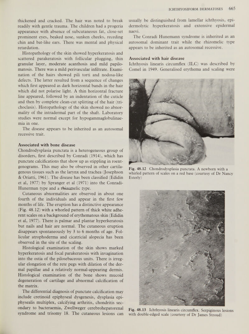 thickened and cracked. The hair was noted to break readily with gentle trauma. The children had a progeria appearance with absence of subcutaneous fat, close-set prominent eyes, beaked nose, sunken cheeks, receding chin and bat-like ears. There was mental and physical retardation. Histopathology of the skin showed hyperkeratosis and scattered parakeratosis with follicular plugging, thin granular layer, moderate acanthosis and mild papilo- matosis. There was a mild perivascular infiltrate. Exami nation of the hairs showed pili torti and nodosa-like defects. The latter resulted from a sequence of changes which first appeared as dark horizontal bands in the hair which did not polarise light. A thin horizontal fracture line appeared, followed by an indentation of the cuticle and then by complete clean-cut splitting of the hair (tri- choclasis). Histopathology of the skin showed no abnor mality of the intradermal part of the shaft. Laboratory studies were normal except for hypogammaglobulinae mia in one. The disease appears to be inherited as an autosomal recessive trait. Associated with bone disease Chondrodysplasia punctata is a heterogeneous group of disorders, first described by Conradi (1914), which has punctate calcifications that show up as stippling in roent genograms. This may also be observed in other cartila- genous tissues such as the larynx and trachea (Josephson & Oriatti, 1961). The disease has been classified (Edidin et al, 1977) by Spranger et al (1971) into the Conradi- Hunerman type and a rhizomelic type. Cutaneous abnormalities are observed in about one fourth of the individuals and appear in the first few months of life. The eruption has a distinctive appearance (Fig. 48.12) with a whorled pattern of thick white adhe rent scales on a background of erythematous skin (Edidin et al, 1977). There is palmar and plantar hyperkeratosis but nails and hair are normal. The cutaneous eruption disappears spontaneously by 3 to 6 months of age. Fol licular atrophoderma and cicatricial alopecia has been observed in the site of the scaling. Histological examination of the skin shows marked hyperkeratosis and focal parakeratosis with invagination into the ostia of the pilosebaceous units. There is irreg ular elongation of the rete pegs with dilation of the der mal papillae and a relatively normal-appearing dermis. Histological examination of the bone shows mucoid degeneration of cartilage and abnormal calcification of the matrix. The differential diagnosis of punctate calcification may include cretinoid epiphyseal dysgenesis, dysplasia epi- physealis multiplex, calcifying arthritis, chondritis sec ondary to bacteraemia, Zwellweger cerebrohepatorenal syndrome and trisomy 18. The cutaneous lesions can usually be distinguished from lamellar ichthyosis, epi- dermolytic hyperkeratosis and extensive epidermal naevi. The Conradi Hunemann syndrome is inherited as an autosomal dominant trait while the rhizomelic type appears to be inherited as an autosomal recessive. Associated with hair disease Ichthyosis linearis circumflex (ILC) was described by Cornel in 1949. Generalised erythema and scaling were Fig. 48.12 Chondrodysplasia punctata. A newborn with a whirled pattern of scales on a red base (courtesy of Dr Nancy Esterly) Fig. 48.13 Ichthyosis linearis circumflex. Serpiginous lesions with double-edged scale (courtesy of Dr James Stroud)