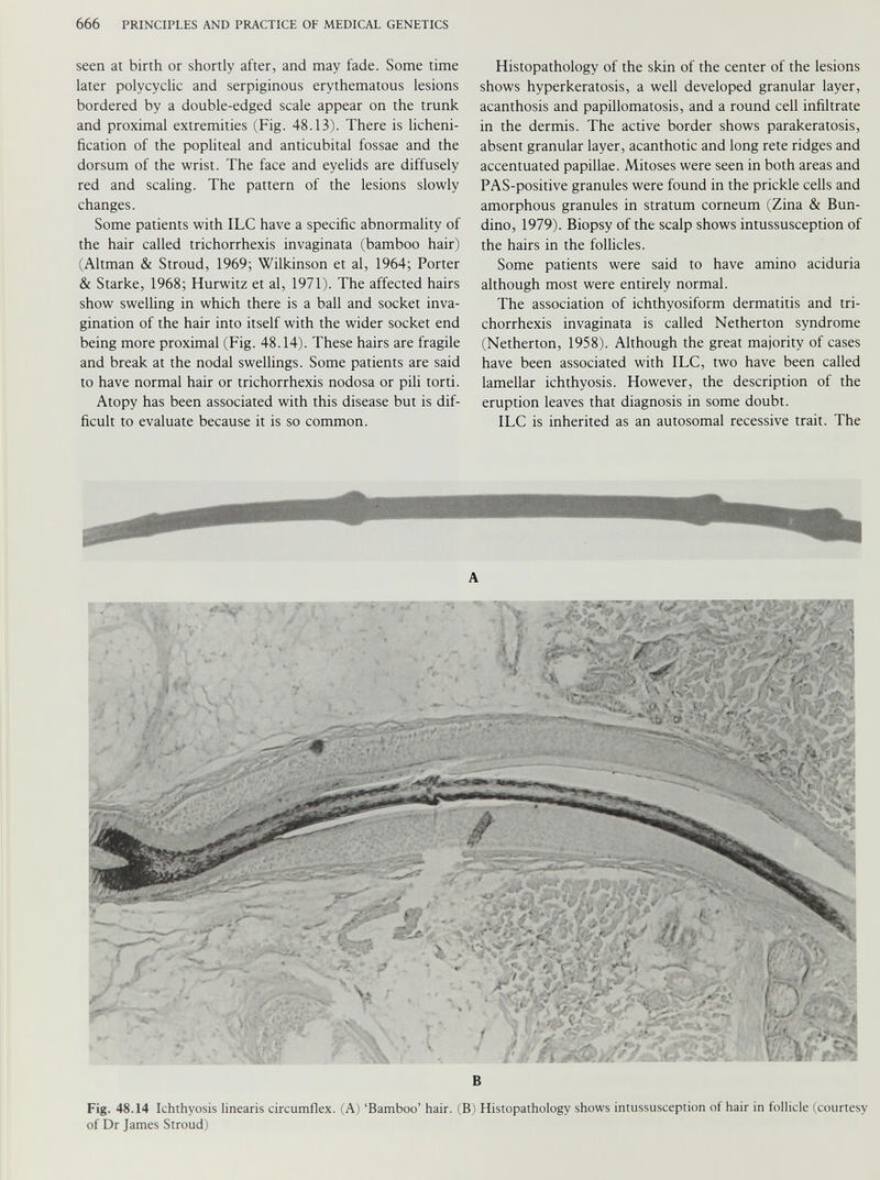seen at birth or shortly after, and may fade. Some time later polycyclic and serpiginous erythematous lesions bordered by a double-edged scale appear on the trunk and proximal extremities (Fig. 48.13). There is lichéni fication of the popliteal and anticubital fossae and the dorsum of the wrist. The face and eyelids are diffusely red and scaling. The pattern of the lesions slowly changes. Some patients with ILC have a specific abnormality of the hair called trichorrhexis invaginata (bamboo hair) (Altman & Stroud, 1969; Wilkinson et al, 1964; Porter & Starke, 1968; Hurwitz et al, 1971). The affected hairs show swelling in which there is a ball and socket inva gination of the hair into itself with the wider socket end being more proximal (Fig. 48.14). These hairs are fragile and break at the nodal swellings. Some patients are said to have normal hair or trichorrhexis nodosa or pili torti. Atopy has been associated with this disease but is dif ficult to evaluate because it is so common. Histopathology of the skin of the center of the lesions shows hyperkeratosis, a well developed granular layer, acanthosis and papillomatosis, and a round cell infiltrate in the dermis. The active border shows parakeratosis, absent granular layer, acanthotic and long rete ridges and accentuated papillae. Mitoses were seen in both areas and PAS-positive granules were found in the prickle cells and amorphous granules in stratum corneum (Zina & Bun- dino, 1979). Biopsy of the scalp shows intussusception of the hairs in the follicles. Some patients were said to have amino aciduria although most were entirely normal. The association of ichthyosiform dermatitis and tri chorrhexis invaginata is called Netherton syndrome (Netherton, 1958). Although the great majority of cases have been associated with ILC, two have been called lamellar ichthyosis. However, the description of the eruption leaves that diagnosis in some doubt. ILC is inherited as an autosomal recessive trait. The A B Fig. 48.14 Ichthyosis linearis circumflex. (A) ‘Bamboo’ hair. (B) Histopathology shows intussusception of hair in follicle (courtesy of Dr James Stroud)