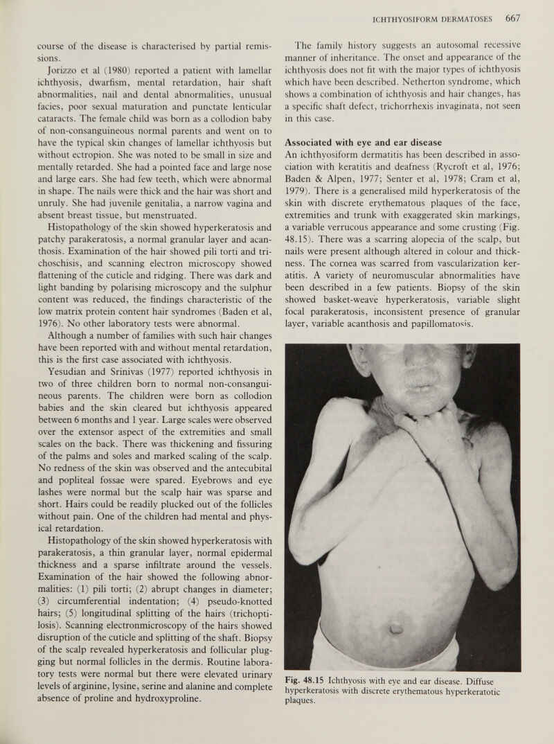 course of the disease is characterised by partial remis sions. Jorizzo et al (1980) reported a patient with lamellar ichthyosis, dwarfism, mental retardation, hair shaft abnormalities, nail and dental abnormalities, unusual facies, poor sexual maturation and punctate lenticular cataracts. The female child was born as a collodion baby of non-consanguineous normal parents and went on to have the typical skin changes of lamellar ichthyosis but without ectropion. She was noted to be small in size and mentally retarded. She had a pointed face and large nose and large ears. She had few teeth, which were abnormal in shape. The nails were thick and the hair was short and unruly. She had juvenile genitalia, a narrow vagina and absent breast tissue, but menstruated. Histopathology of the skin showed hyperkeratosis and patchy parakeratosis, a normal granular layer and acan thosis. Examination of the hair showed pili torti and tri choschisis, and scanning electron microscopy showed flattening of the cuticle and ridging. There was dark and light banding by polarising microscopy and the sulphur content was reduced, the findings characteristic of the low matrix protein content hair syndromes (Baden et al, 1976). No other laboratory tests were abnormal. Although a number of families with such hair changes have been reported with and without mental retardation, this is the first case associated with ichthyosis. Yesudian and Srinivas (1977) reported ichthyosis in two of three children born to normal non-consangui- neous parents. The children were born as collodion babies and the skin cleared but ichthyosis appeared between 6 months and 1 year. Large scales were observed over the extensor aspect of the extremities and small scales on the back. There was thickening and Assuring of the palms and soles and marked scaling of the scalp. No redness of the skin was observed and the antecubital and popliteal fossae were spared. Eyebrows and eye lashes were normal but the scalp hair was sparse and short. Hairs could be readily plucked out of the follicles without pain. One of the children had mental and phys ical retardation. Histopathology of the skin showed hyperkeratosis with parakeratosis, a thin granular layer, normal epidermal thickness and a sparse infiltrate around the vessels. Examination of the hair showed the following abnor malities: (1) pili torti; (2) abrupt changes in diameter; (3) circumferential indentation; (4) pseudo-knotted hairs; (5) longitudinal splitting of the hairs (trichopti- losis). Scanning electronmicroscopy of the hairs showed disruption of the cuticle and splitting of the shaft. Biopsy of the scalp revealed hyperkeratosis and follicular plug ging but normal follicles in the dermis. Routine labora tory tests were normal but there were elevated urinary levels of arginine, lysine, serine and alanine and complete absence of proline and hydroxyproline. The family history suggests an autosomal recessive manner of inheritance. The onset and appearance of the ichthyosis does not fit with the major types of ichthyosis which have been described. Netherton syndrome, which shows a combination of ichthyosis and hair changes, has a specific shaft defect, trichorrhexis invaginata, not seen in this case. Associated with eye and ear disease An ichthyosiform dermatitis has been described in asso ciation with keratitis and deafness (Rycroft et al, 1976; Baden & Alpen, 1977; Senter et al, 1978; Cram et al, 1979). There is a generalised mild hyperkeratosis of the skin with discrete erythematous plaques of the face, extremities and trunk with exaggerated skin markings, a variable verrucous appearance and some crusting (Fig. 48.15). There was a scarring alopecia of the scalp, but nails were present although altered in colour and thick ness. The cornea was scarred from vascularization ker atitis. A variety of neuromuscular abnormalities have been described in a few patients. Biopsy of the skin showed basket-weave hyperkeratosis, variable slight focal parakeratosis, inconsistent presence of granular layer, variable acanthosis and papillomatosis. Fig. 48.15 Ichthyosis with eye and ear disease. Diffuse hyperkeratosis with discrete erythematous hyperkeratotic plaques.