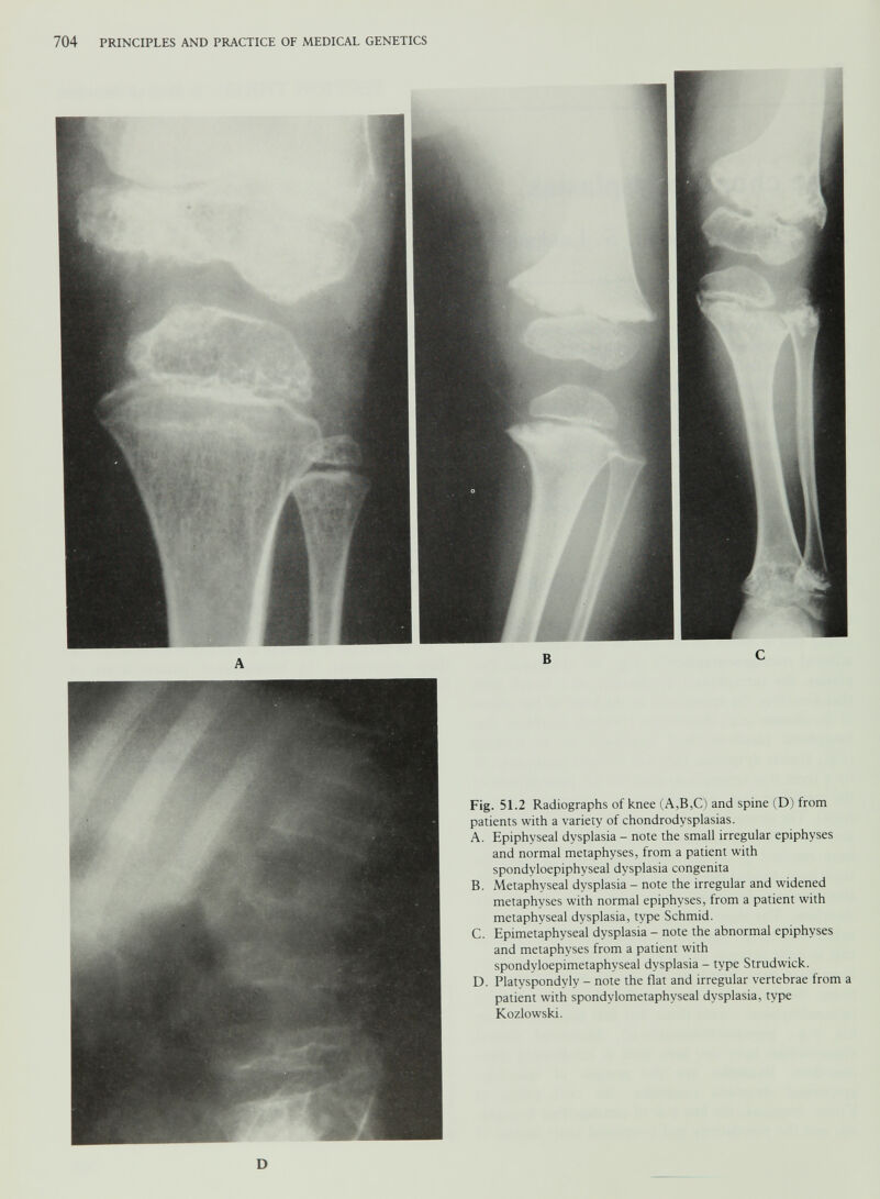 Fig. 51.2 Radiographs of knee (A,B,C) and spine (D) from patients with a variety of chondrodysplasias. A. Epiphyseal dysplasia - note the small irregular epiphyses and normal metaphyses, from a patient with spondyloepiphyseal dysplasia congenita B. Metaphyseal dysplasia - note the irregular and widened metaphyses with normal epiphyses, from a patient with metaphyseal dysplasia, type Schmid. C. Epimetaphyseal dysplasia - note the abnormal epiphyses and metaphyses from a patient with spondyloepimetaphyseal dysplasia - type Strudwick. D. Platyspondyly - note the flat and irregular vertebrae from a patient with spondylometaphyseal dysplasia, type Kozlowski. D