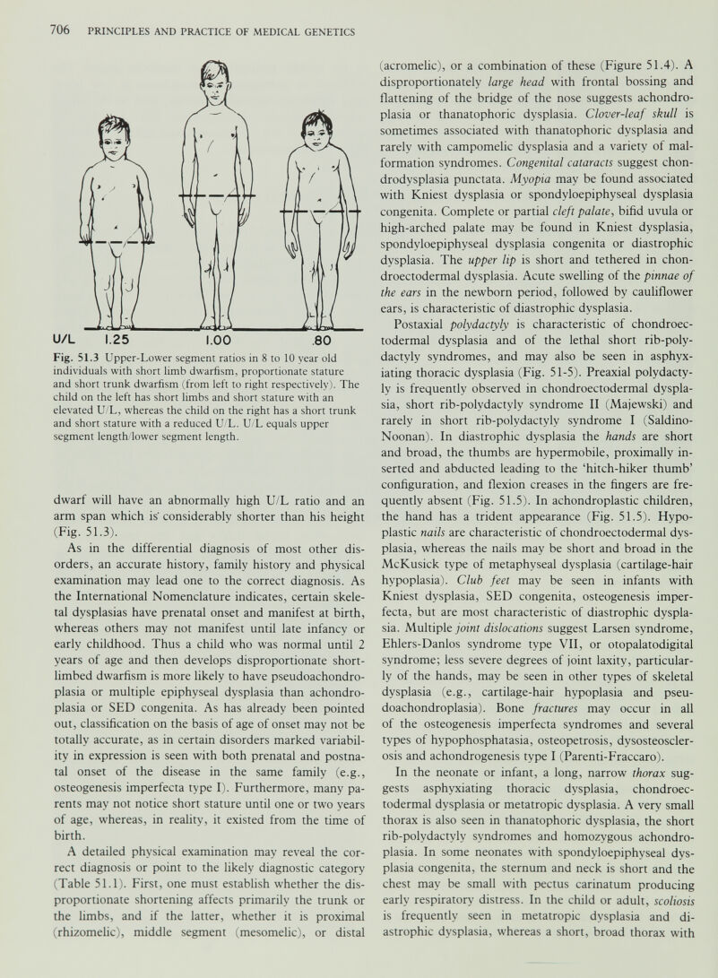 Fig. 51.3 Upper-Lower segment ratios in 8 to 10 year old individuals with short limb dwarfism, proportionate stature and short trunk dwarfism (from left to right respectively). The child on the left has short limbs and short stature with an elevated U/L, whereas the child on the right has a short trunk and short stature with a reduced U/L. U/L equals upper segment length/lower segment length. dwarf will have an abnormally high U/L ratio and an arm span which is' considerably shorter than his height (Fig. 51.3). As in the differential diagnosis of most other dis orders, an accurate history, family history and physical examination may lead one to the correct diagnosis. As the International Nomenclature indicates, certain skele tal dysplasias have prenatal onset and manifest at birth, whereas others may not manifest until late infancy or early childhood. Thus a child who was normal until 2 years of age and then develops disproportionate short- limbed dwarfism is more likely to have pseudoachondro plasia or multiple epiphyseal dysplasia than achondro plasia or SED congenita. As has already been pointed out, classification on the basis of age of onset may not be totally accurate, as in certain disorders marked variabil ity in expression is seen with both prenatal and postna tal onset of the disease in the same family (e.g., osteogenesis imperfecta type I). Furthermore, many pa rents may not notice short stature until one or two years of age, whereas, in reality, it existed from the time of birth. A detailed physical examination may reveal the cor rect diagnosis or point to the likely diagnostic category (Table 51.1). First, one must establish whether the dis proportionate shortening affects primarily the trunk or the limbs, and if the latter, whether it is proximal (rhizomelic), middle segment (mesomelic), or distal (acromelic), or a combination of these (Figure 51.4). A disproportionately large head with frontal bossing and flattening of the bridge of the nose suggests achondro plasia or thanatophoric dysplasia. Clover-leaf skull is sometimes associated with thanatophoric dysplasia and rarely with campomelic dysplasia and a variety of mal formation syndromes. Congenital cataracts suggest chon drodysplasia punctata. Myopia may be found associated with Kniest dysplasia or spondyloepiphyseal dysplasia congenita. Complete or partial cleft palate , bifid uvula or high-arched palate may be found in Kniest dysplasia, spondyloepiphyseal dysplasia congenita or diastrophic dysplasia. The upper lip is short and tethered in chon- droectodermal dysplasia. Acute swelling of the pinnae of the ears in the newborn period, followed by cauliflower ears, is characteristic of diastrophic dysplasia. Postaxial polydactyly is characteristic of chondroec- todermal dysplasia and of the lethal short rib-poly- dactyly syndromes, and may also be seen in asphyx iating thoracic dysplasia (Fig. 51-5). Preaxial polydacty ly is frequently observed in chondroectodermal dyspla sia, short rib-polydactyly syndrome II (Majewski) and rarely in short rib-polydactyly syndrome I (Saldino- Noonan). In diastrophic dysplasia the hands are short and broad, the thumbs are hypermobile, proximally in serted and abducted leading to the ‘hitch-hiker thumb’ configuration, and flexion creases in the fingers are fre quently absent (Fig. 51.5). In achondroplastic children, the hand has a trident appearance (Fig. 51.5). Hypo plastic nails are characteristic of chondroectodermal dys plasia, whereas the nails may be short and broad in the McKusick type of metaphyseal dysplasia (cartilage-hair hypoplasia). Club feet may be seen in infants with Kniest dysplasia, SED congenita, osteogenesis imper fecta, but are most characteristic of diastrophic dyspla sia. Multiple joint dislocations suggest Larsen syndrome, Ehlers-Danlos syndrome type VII, or otopalatodigital syndrome; less severe degrees of joint laxity, particular ly of the hands, may be seen in other types of skeletal dysplasia (e.g., cartilage-hair hypoplasia and pseu doachondroplasia). Bone fractures may occur in all of the osteogenesis imperfecta syndromes and several types of hypophosphatasia, osteopetrosis, dysosteoscler- osis and achondrogenesis type I (Parenti-Fraccaro). In the neonate or infant, a long, narrow thorax sug gests asphyxiating thoracic dysplasia, chondroec todermal dysplasia or metatropic dysplasia. A very small thorax is also seen in thanatophoric dysplasia, the short rib-polydactyly syndromes and homozygous achondro plasia. In some neonates with spondyloepiphyseal dys plasia congenita, the sternum and neck is short and the chest may be small with pectus carinatum producing early respiratory distress. In the child or adult, scoliosis is frequently seen in metatropic dysplasia and di astrophic dysplasia, whereas a short, broad thorax with